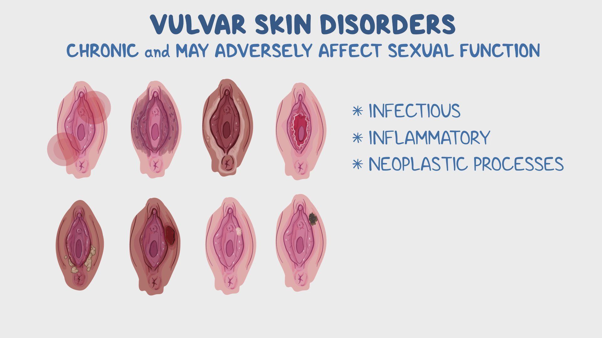 Canker Sore Vulva