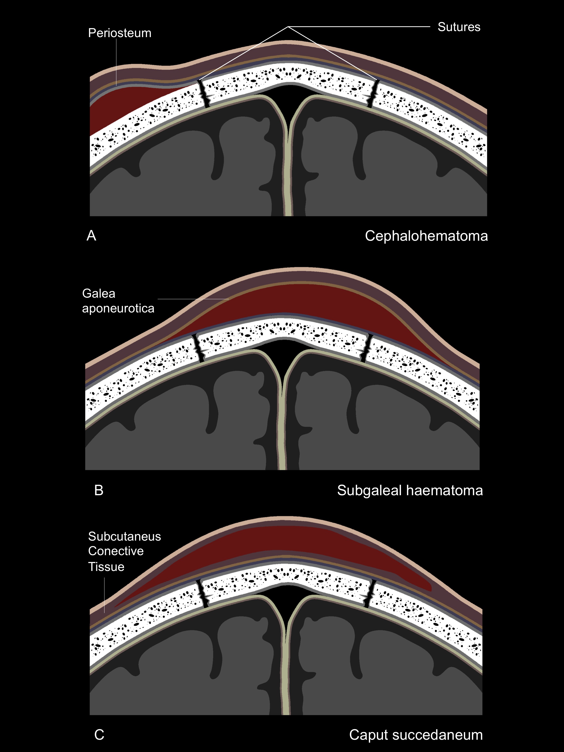 Caput Vs Cephalohematoma