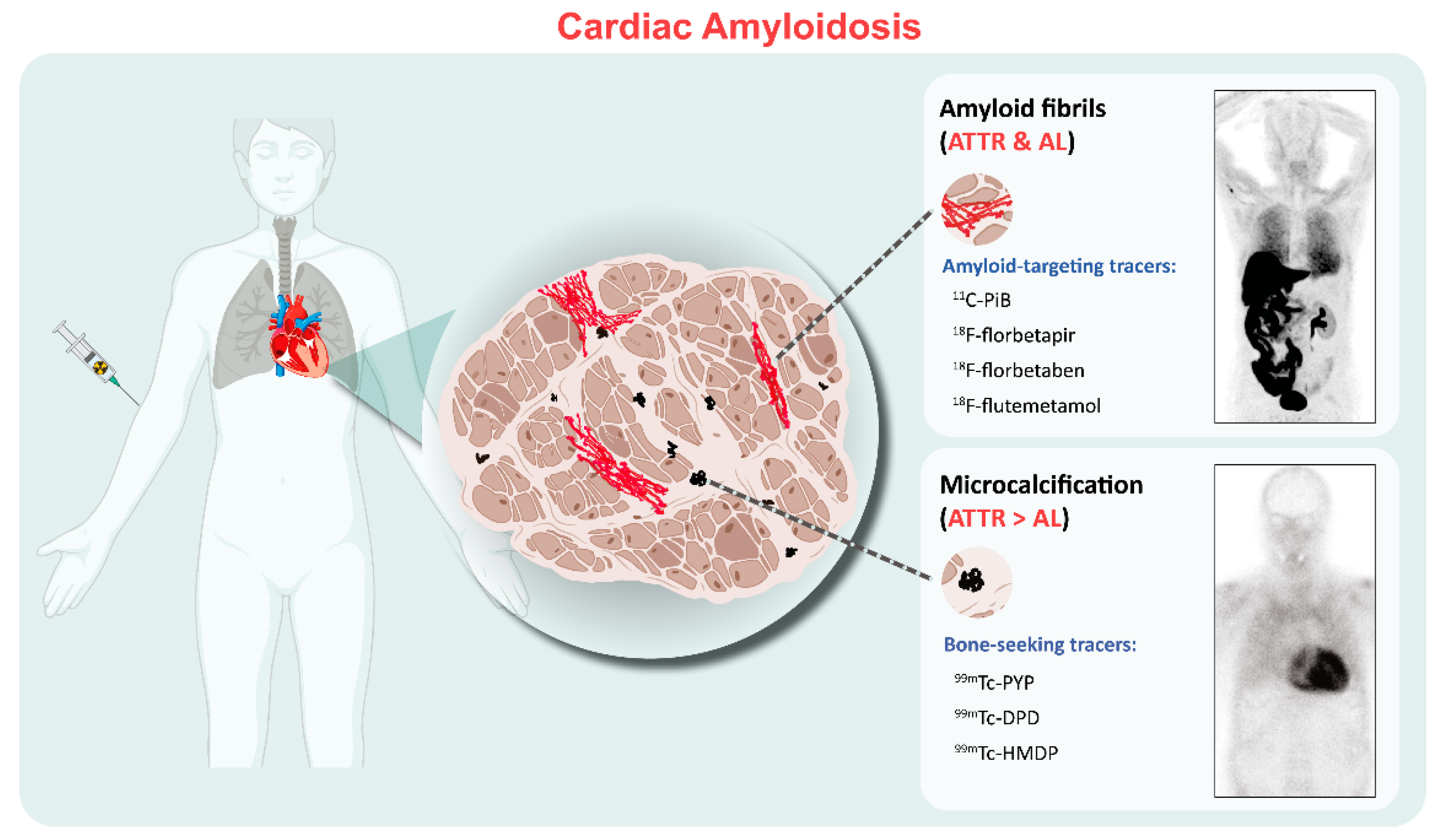 Cardiac Amyloidosis Treatment