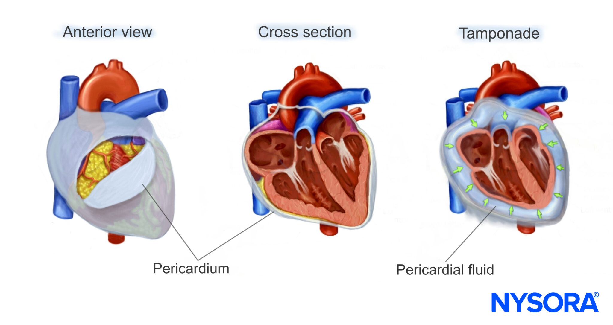 Cardiac Tamponade Vs Pericardial Effusion