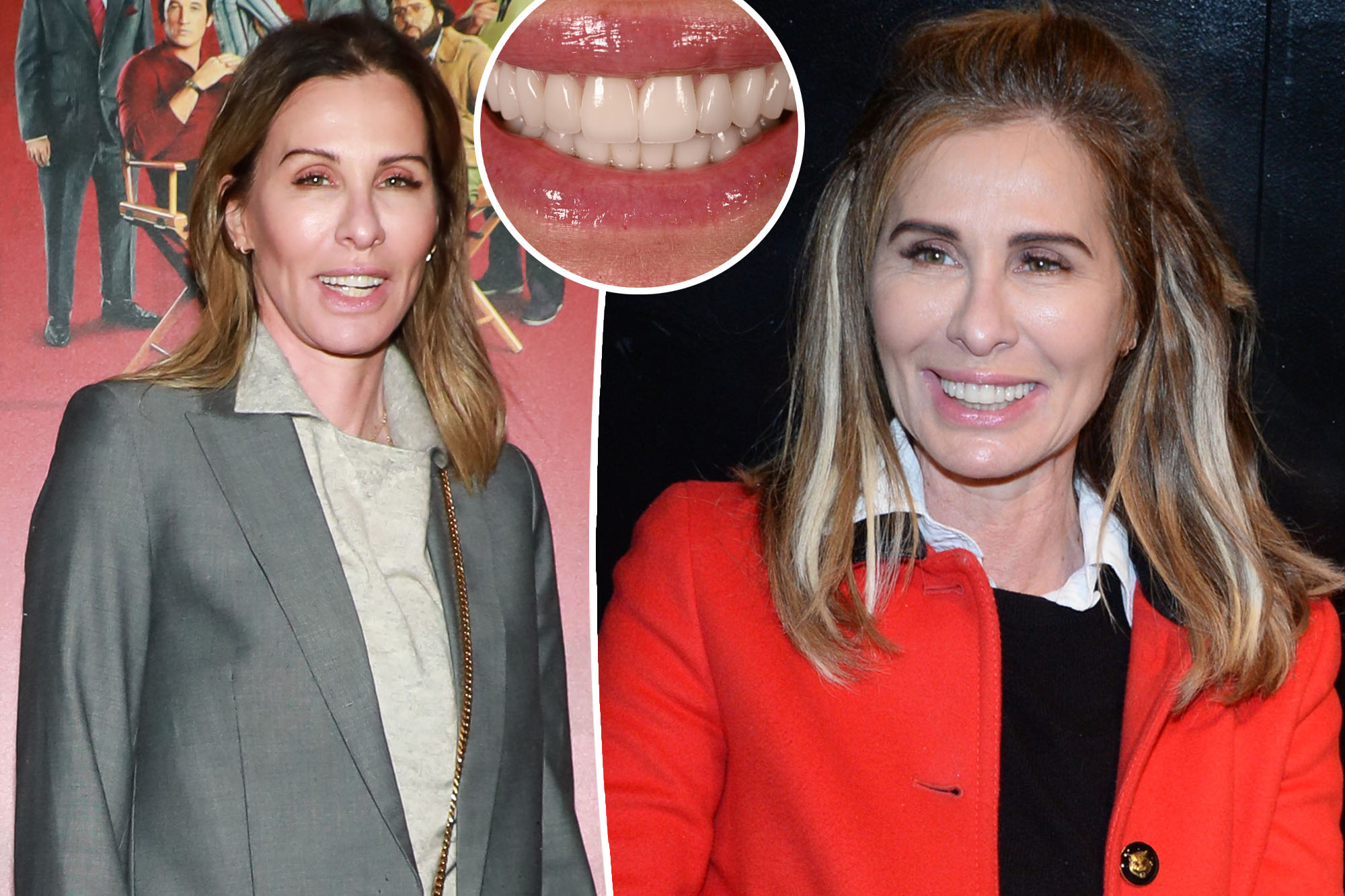 Carole Radziwill Face Surgery