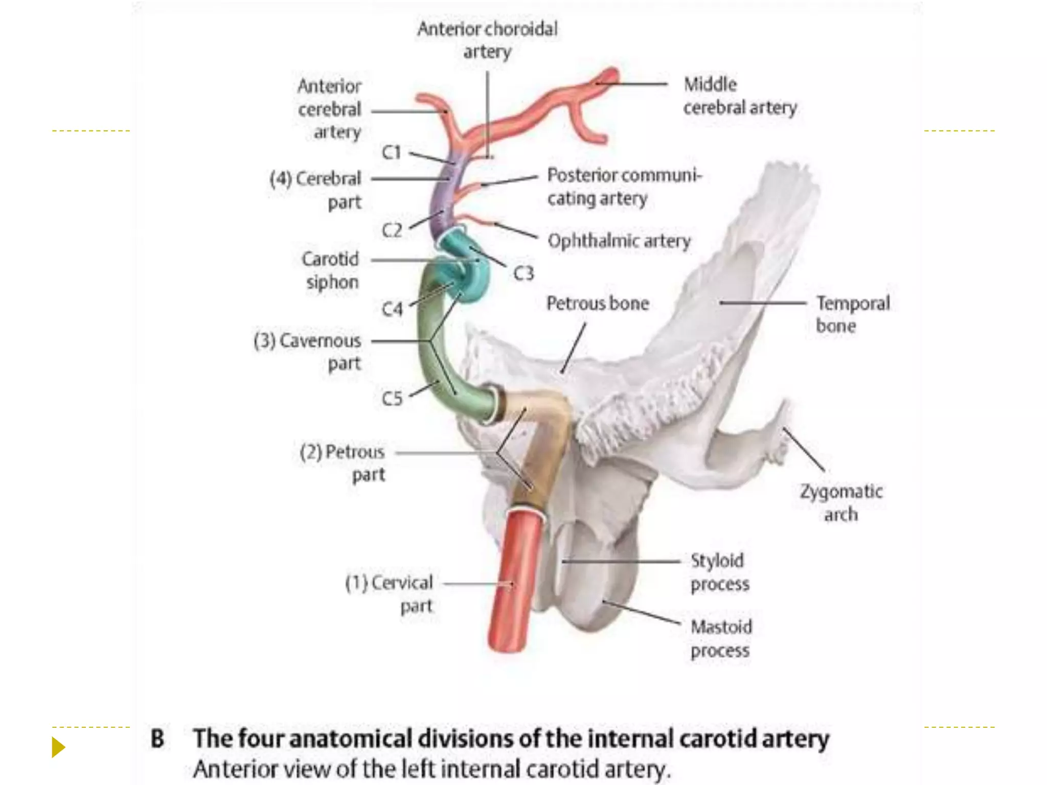 Carotid Cavernous Fistula