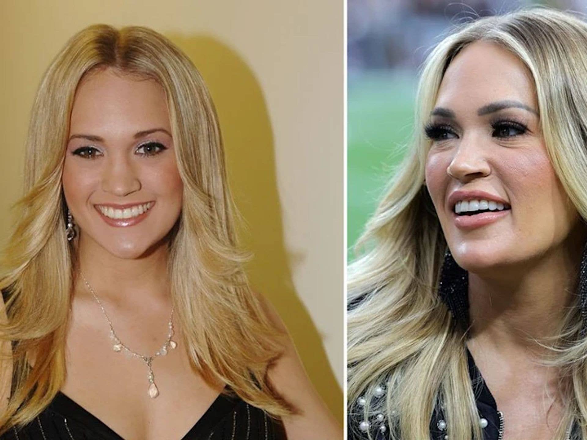 Carrie Underwood Before Face Surgery