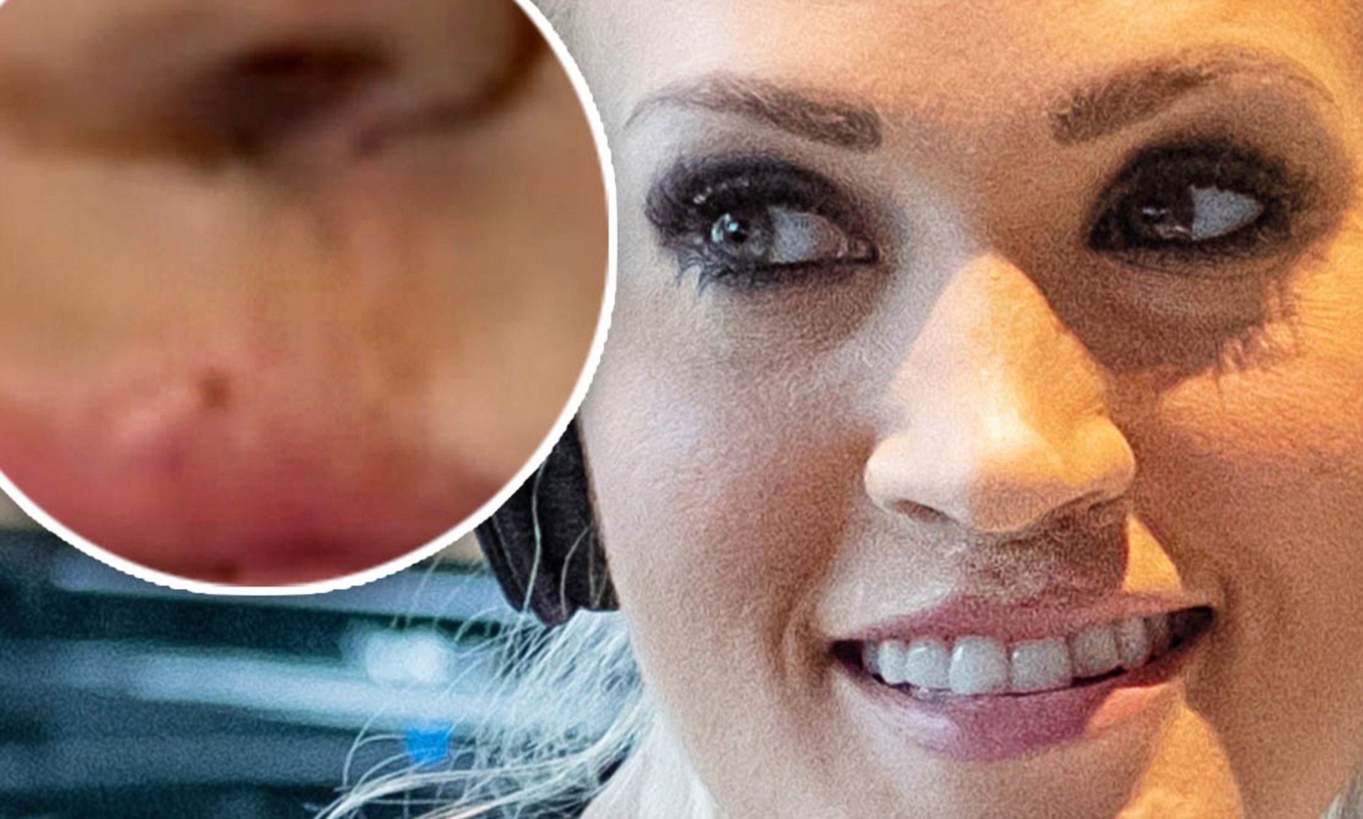 Carrie Underwood Surgery On Face