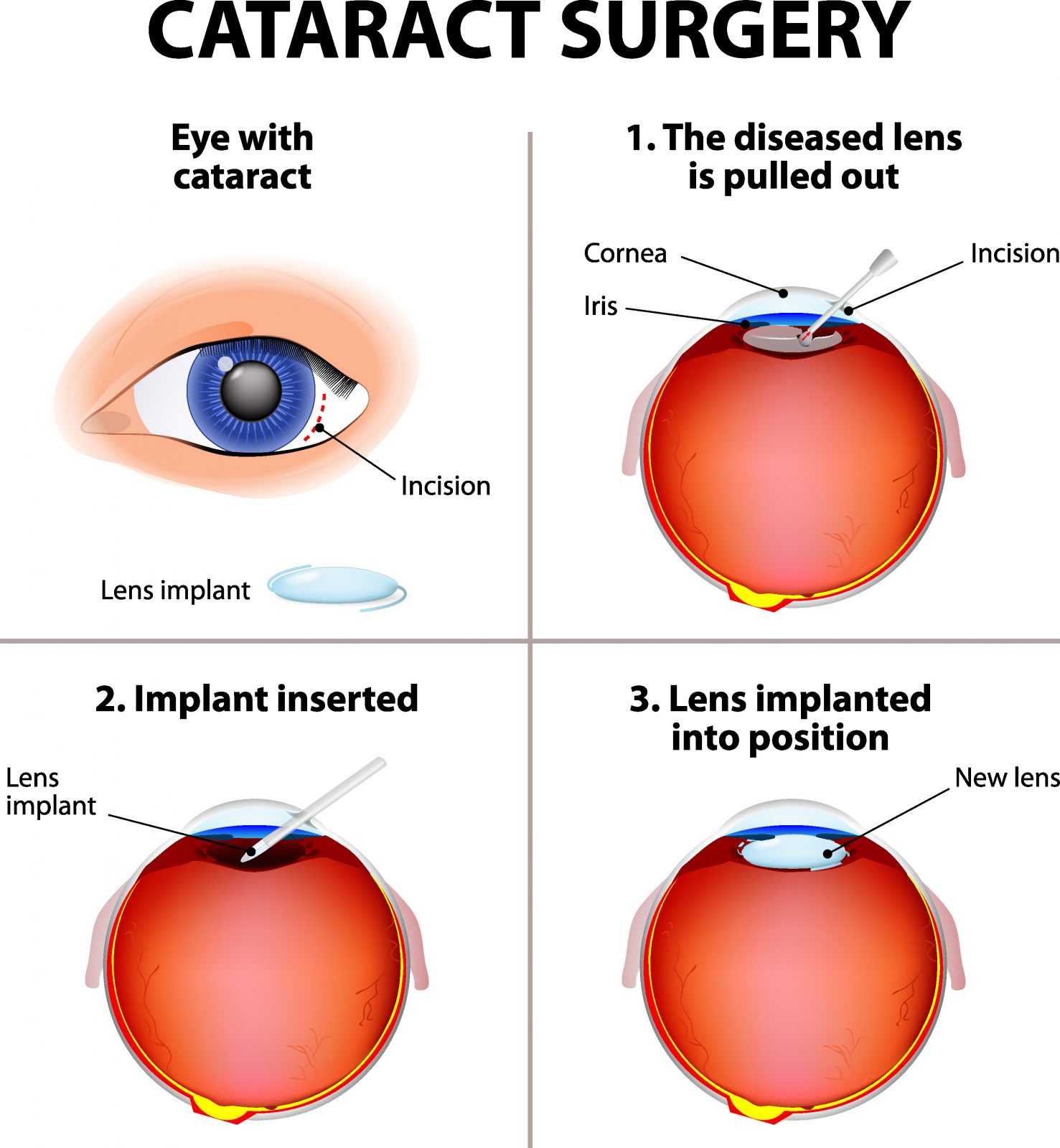 Cataract Lens Replacement
