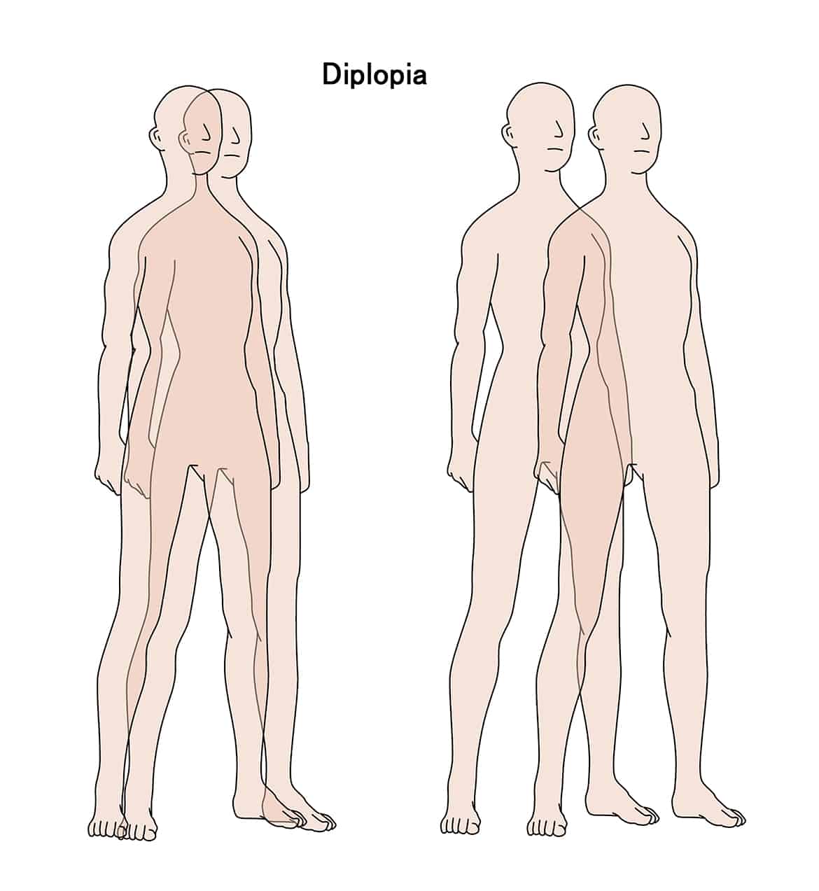 Causes Of Double Vision