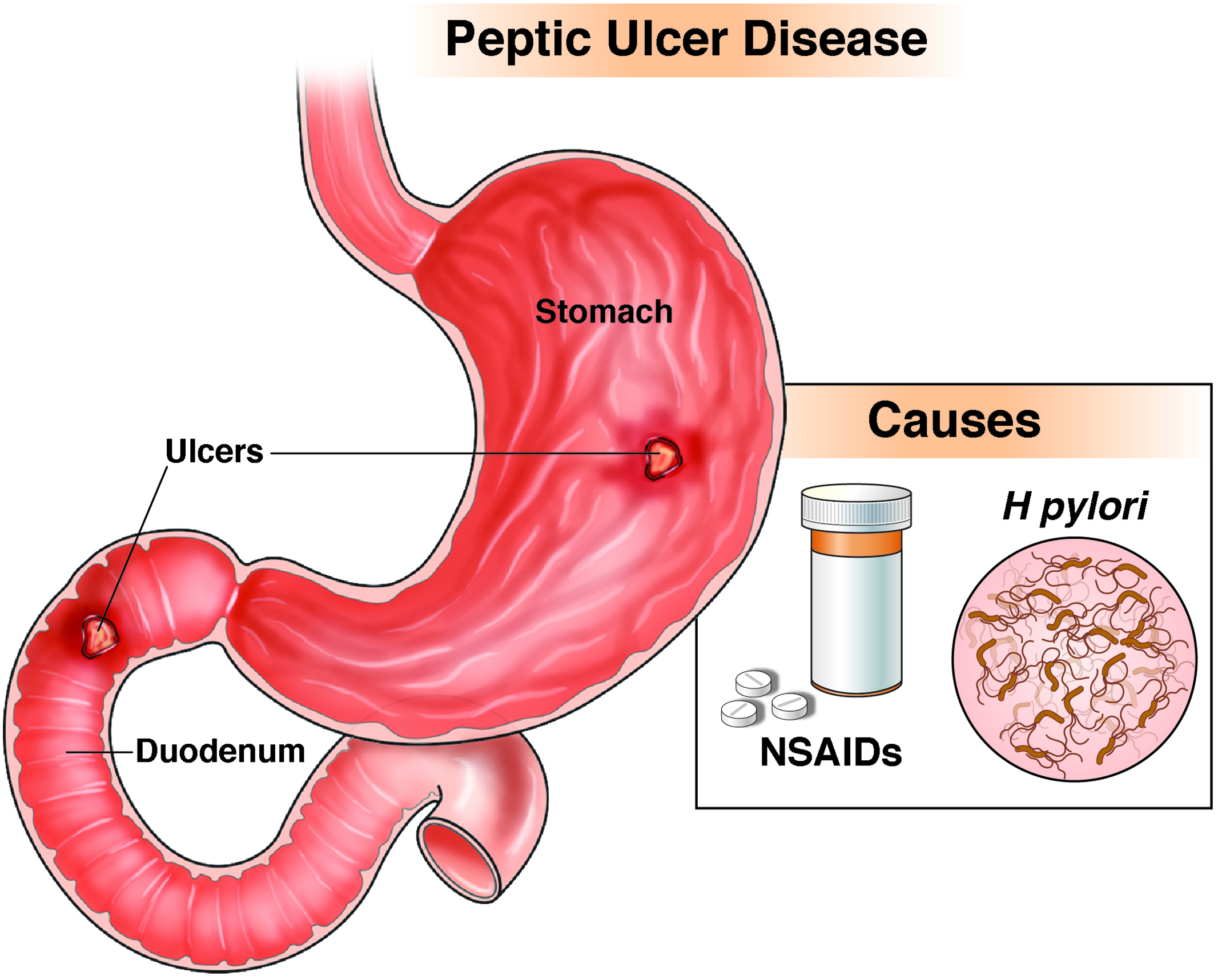 Causes Of Gastric Ulcers
