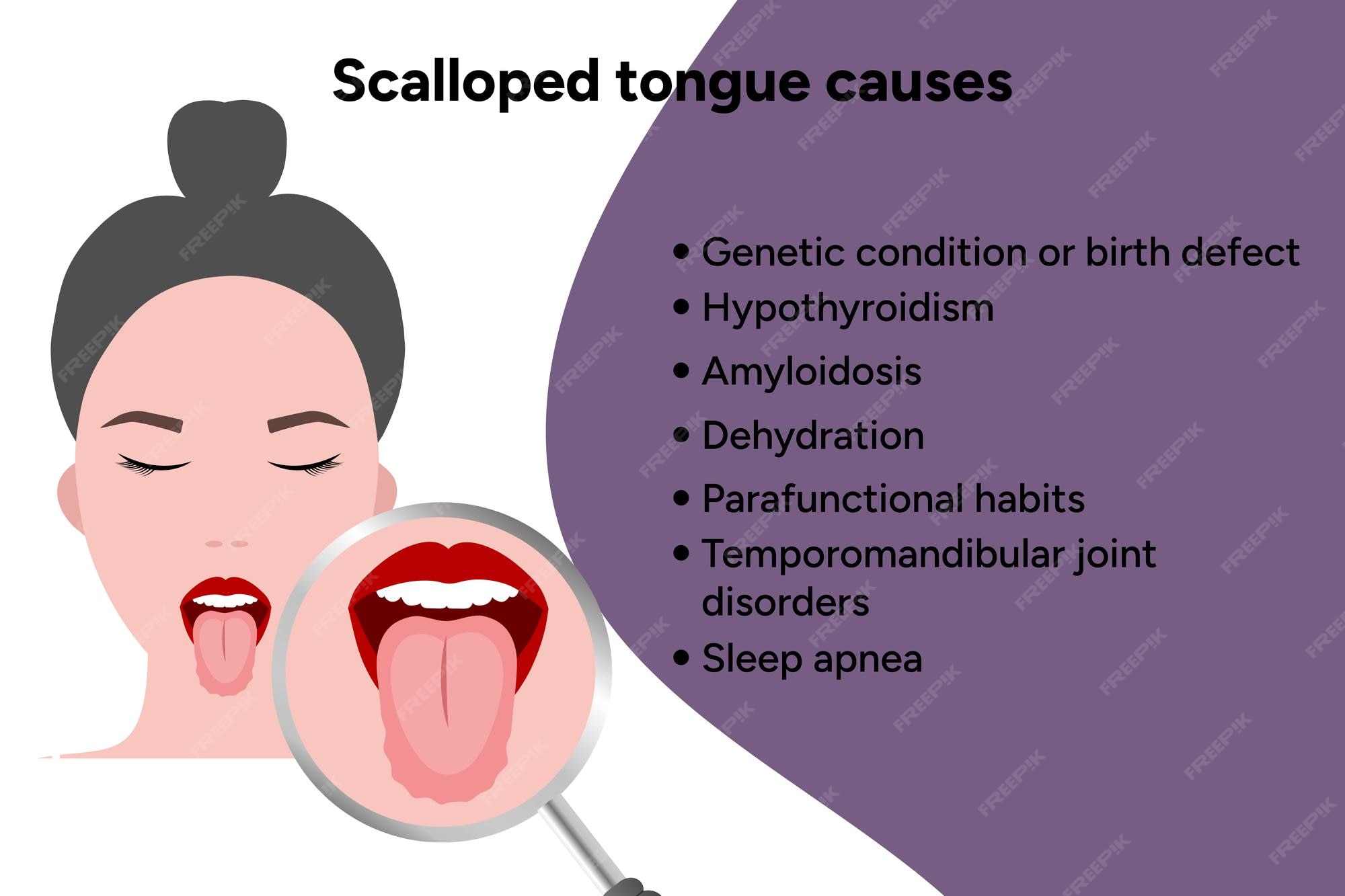 Causes Scalloped Tongue