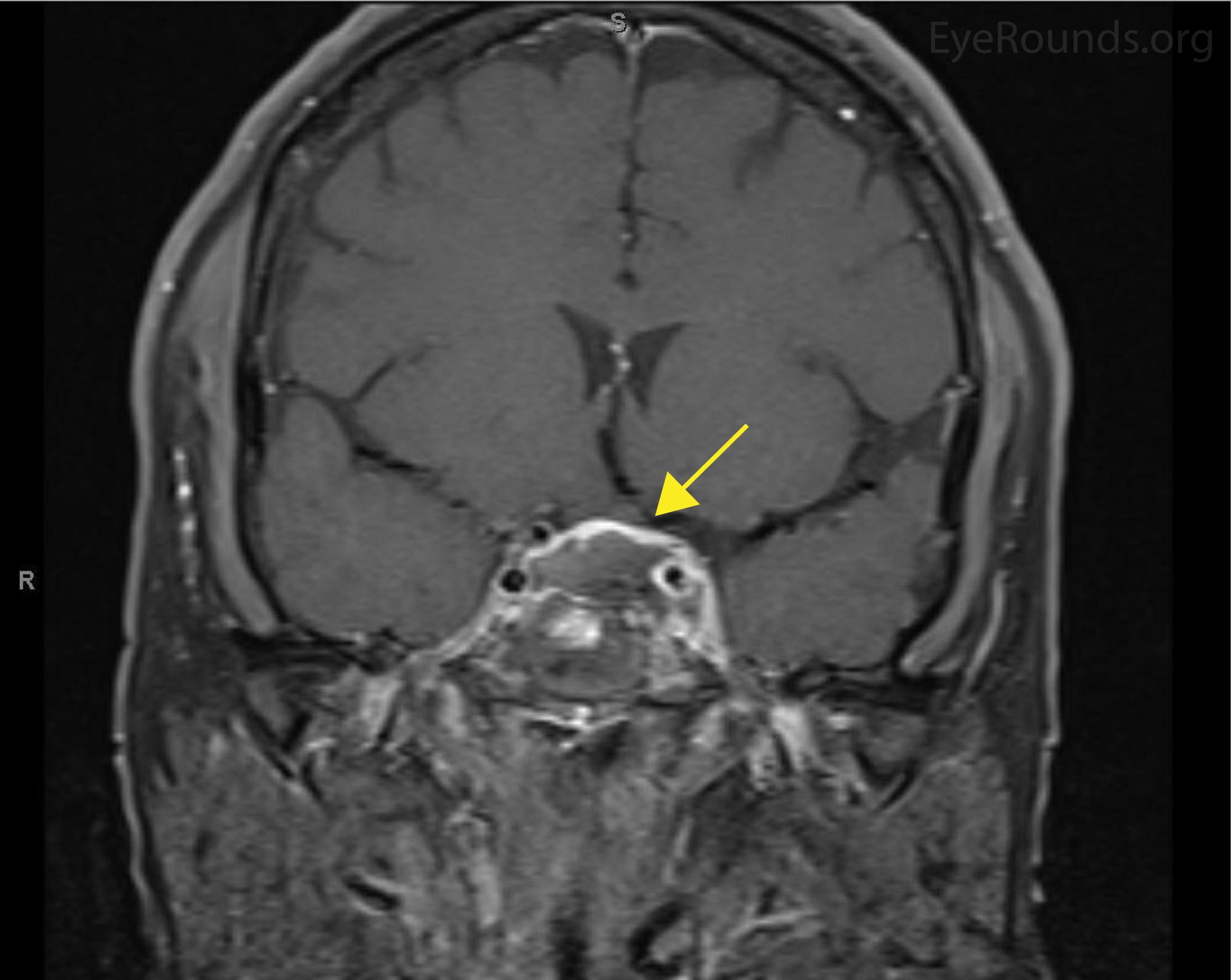 Cavernous Sinus Syndrome