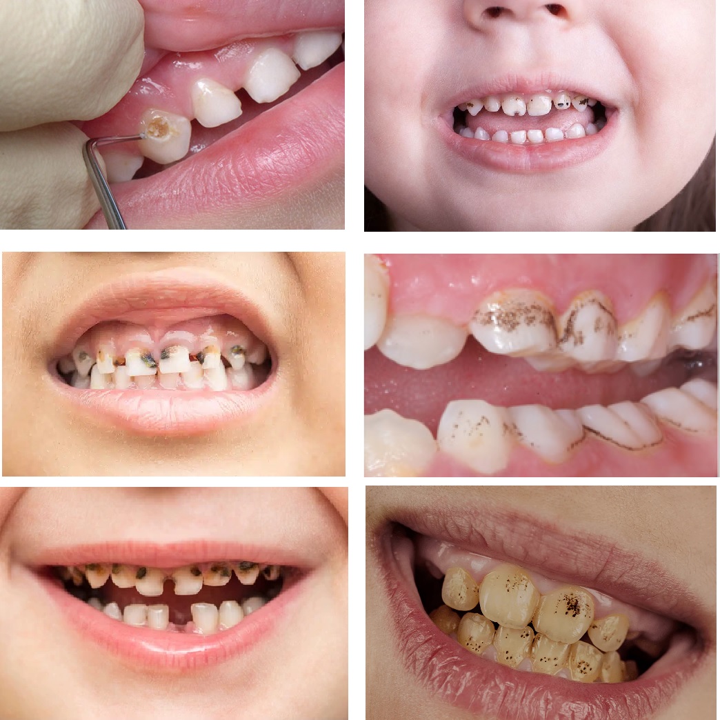 Cavities Between Teeth