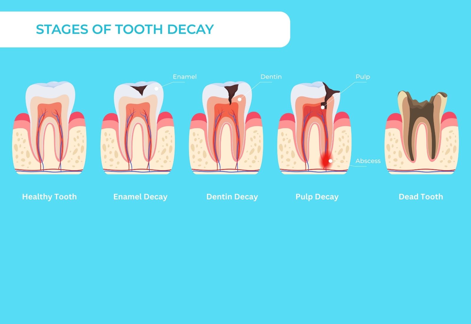 Cavities In Teeth Stages