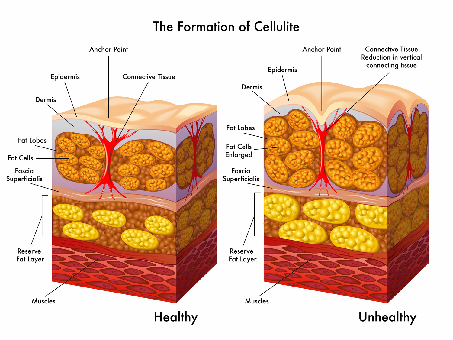 Cellulite Cellulite Cellulite