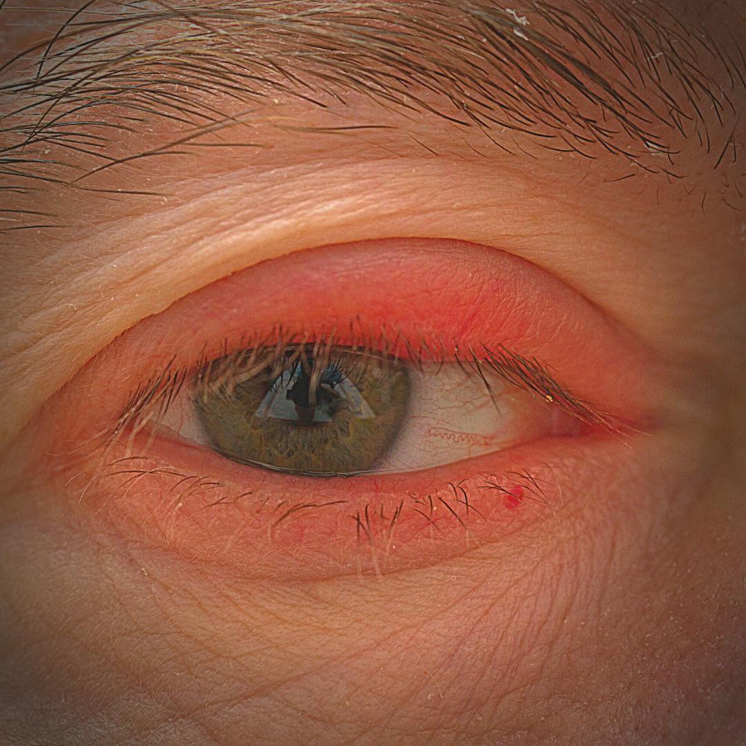 Cellulitis On The Eye