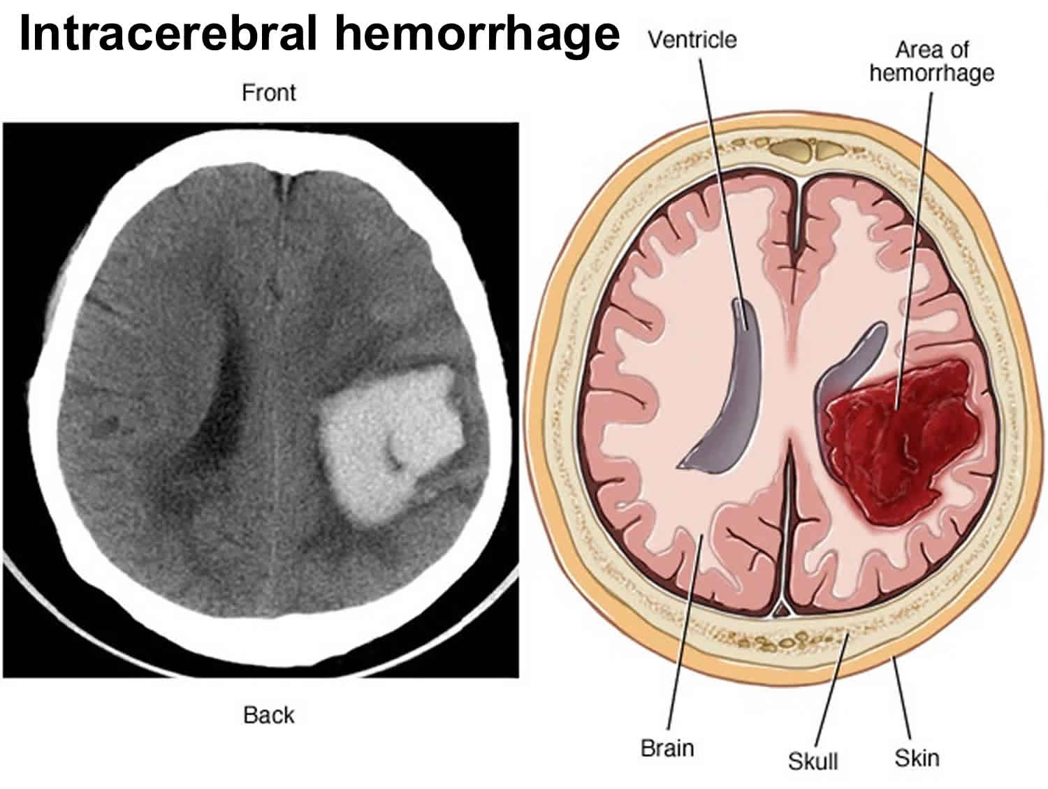 Cerebral Haemorrhage Recovery