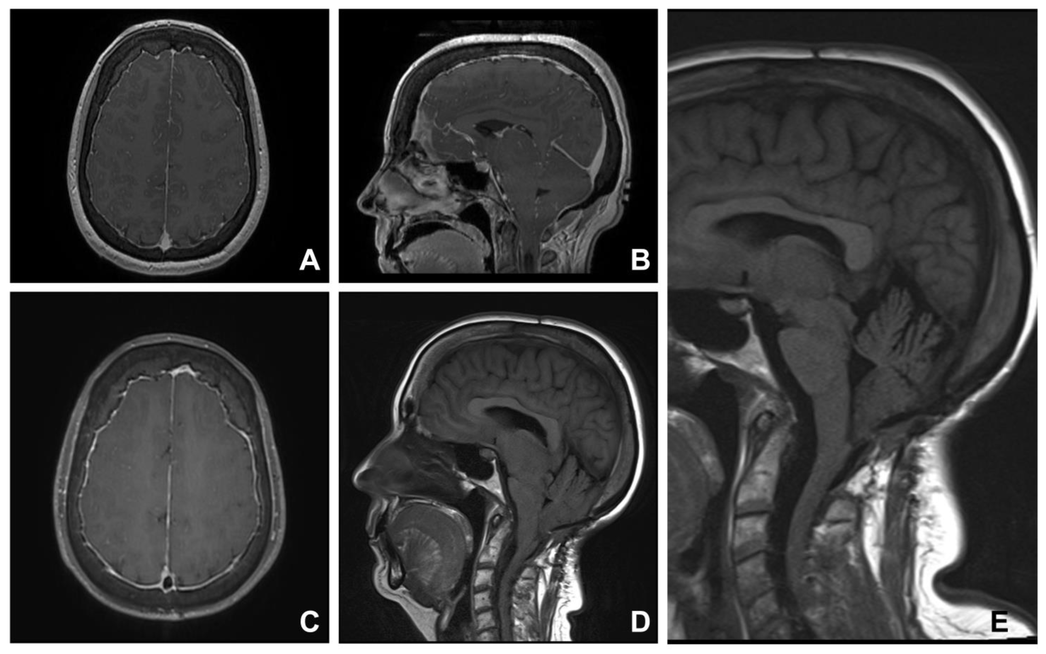 Cerebral Tonsils Low Lying