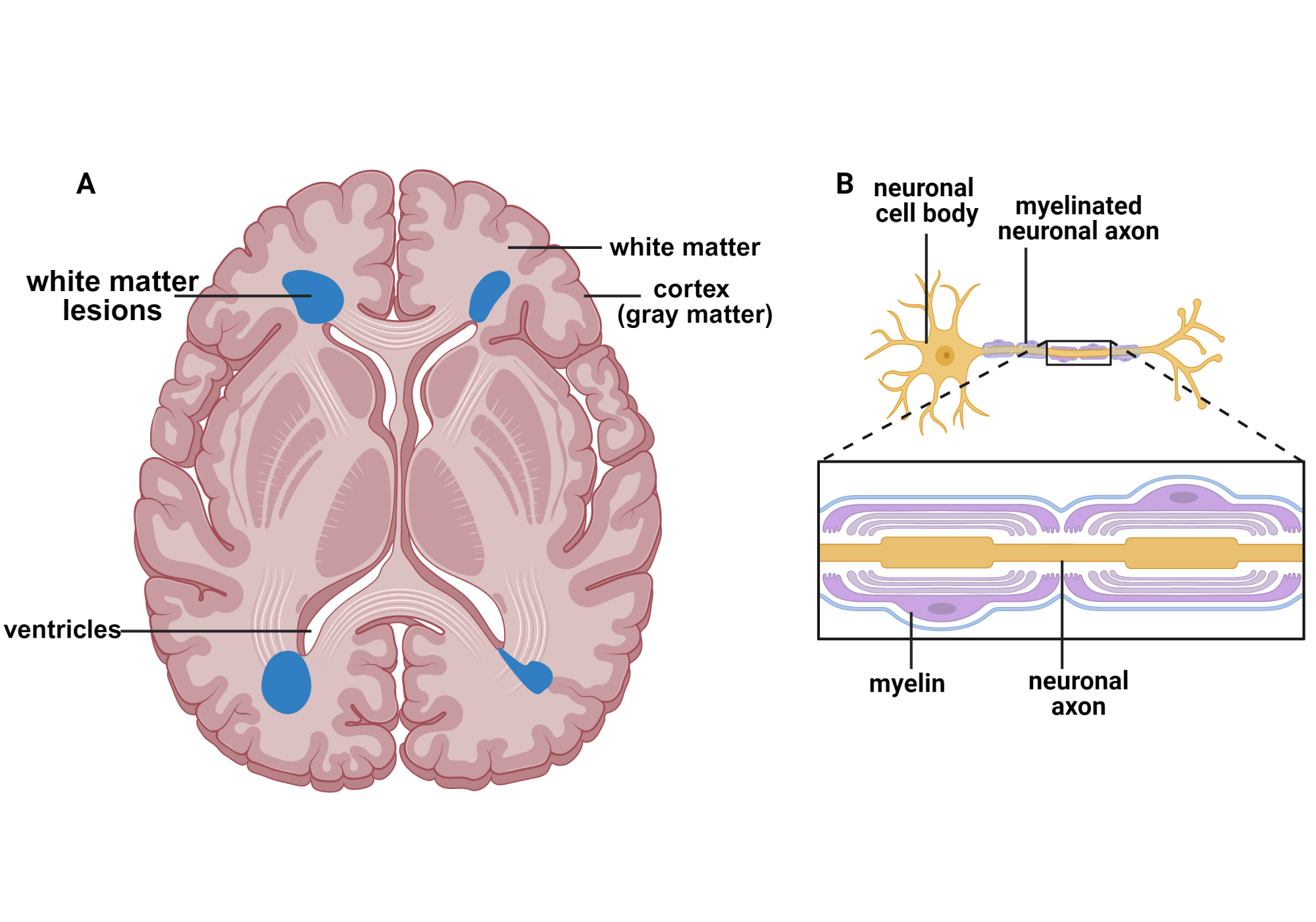 Cerebral White Matter Disease