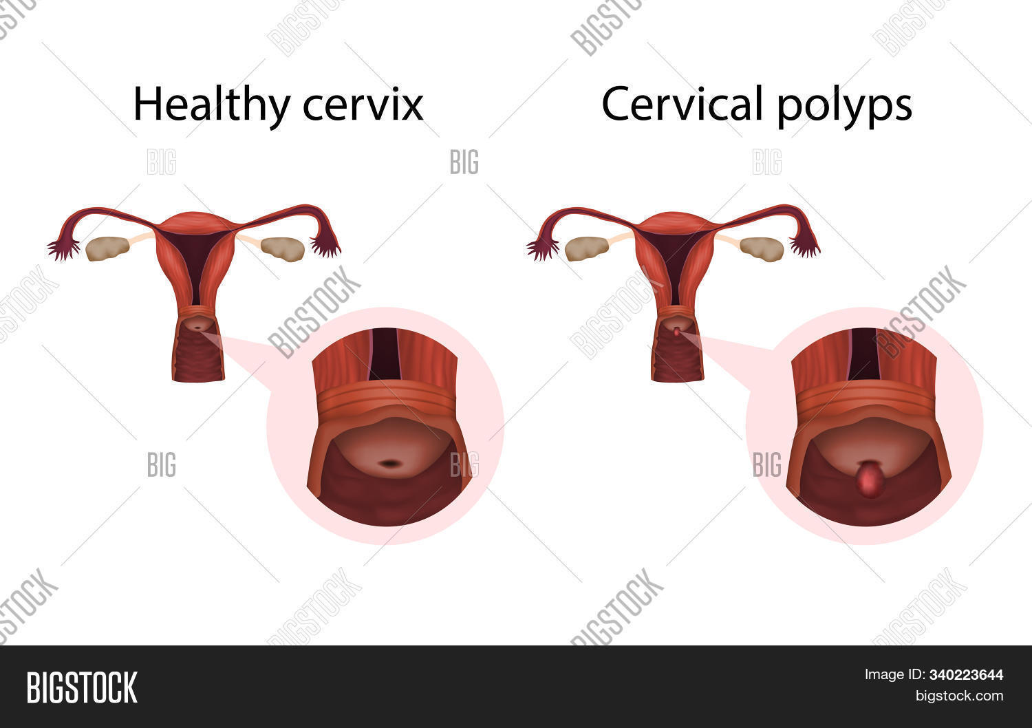 Cervical Polyp Pictures