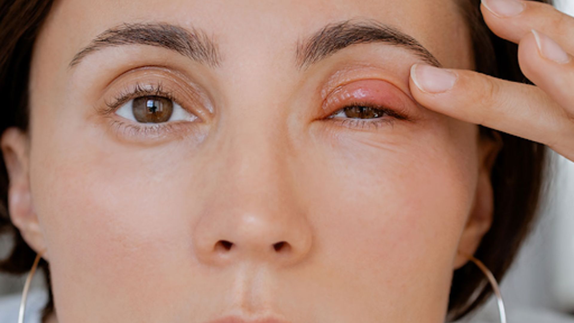 Chalazion Healing Stages