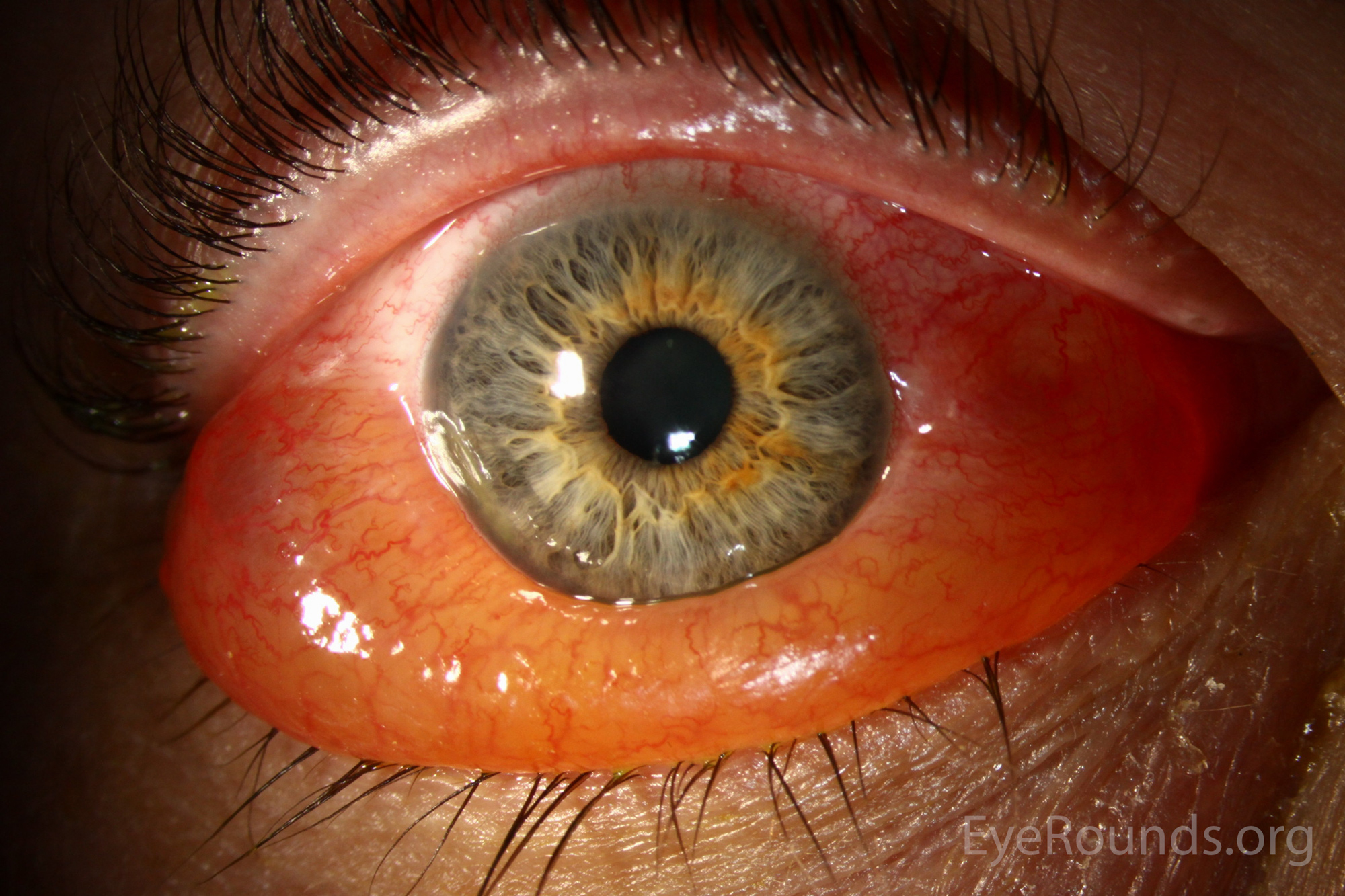 Chemosis In The Eye