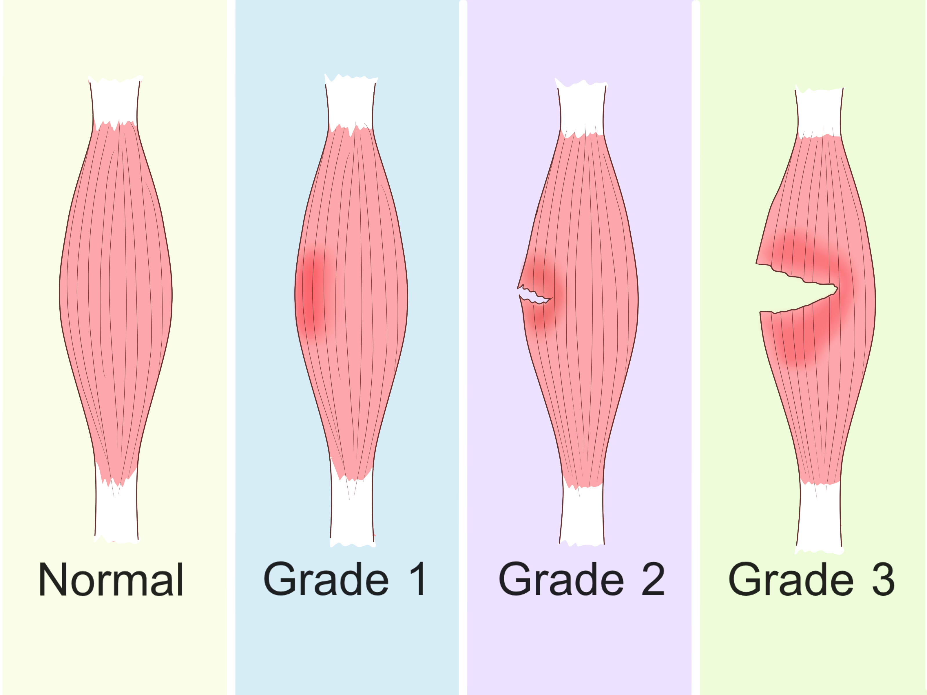 Chest Muscle Strain