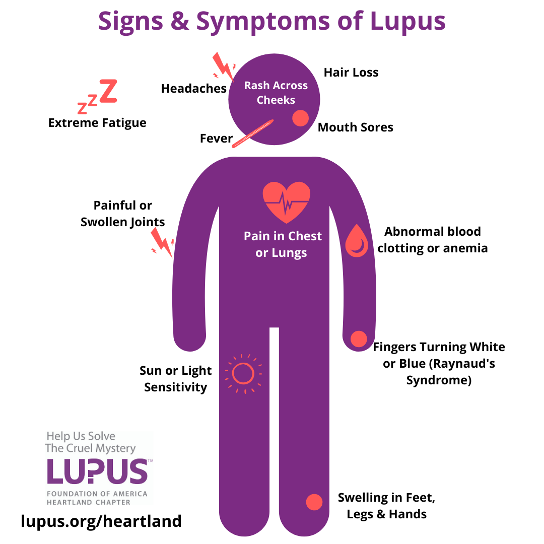 Childhood Lupus Symptoms Signs