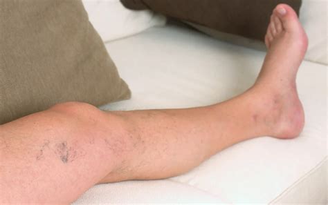 Chronic Venous Insufficiency Fatal