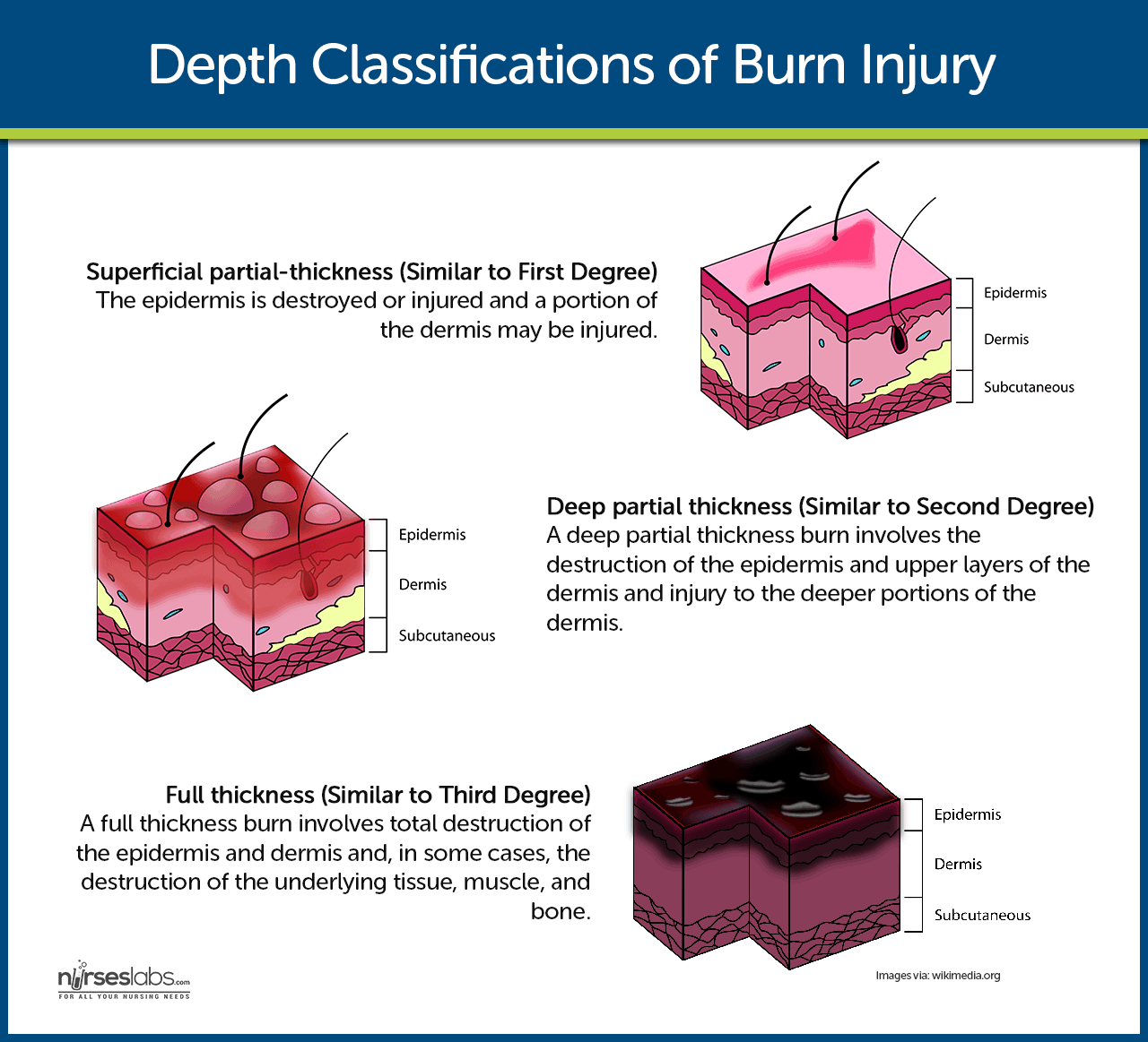 Classification Of Burns According To Depth