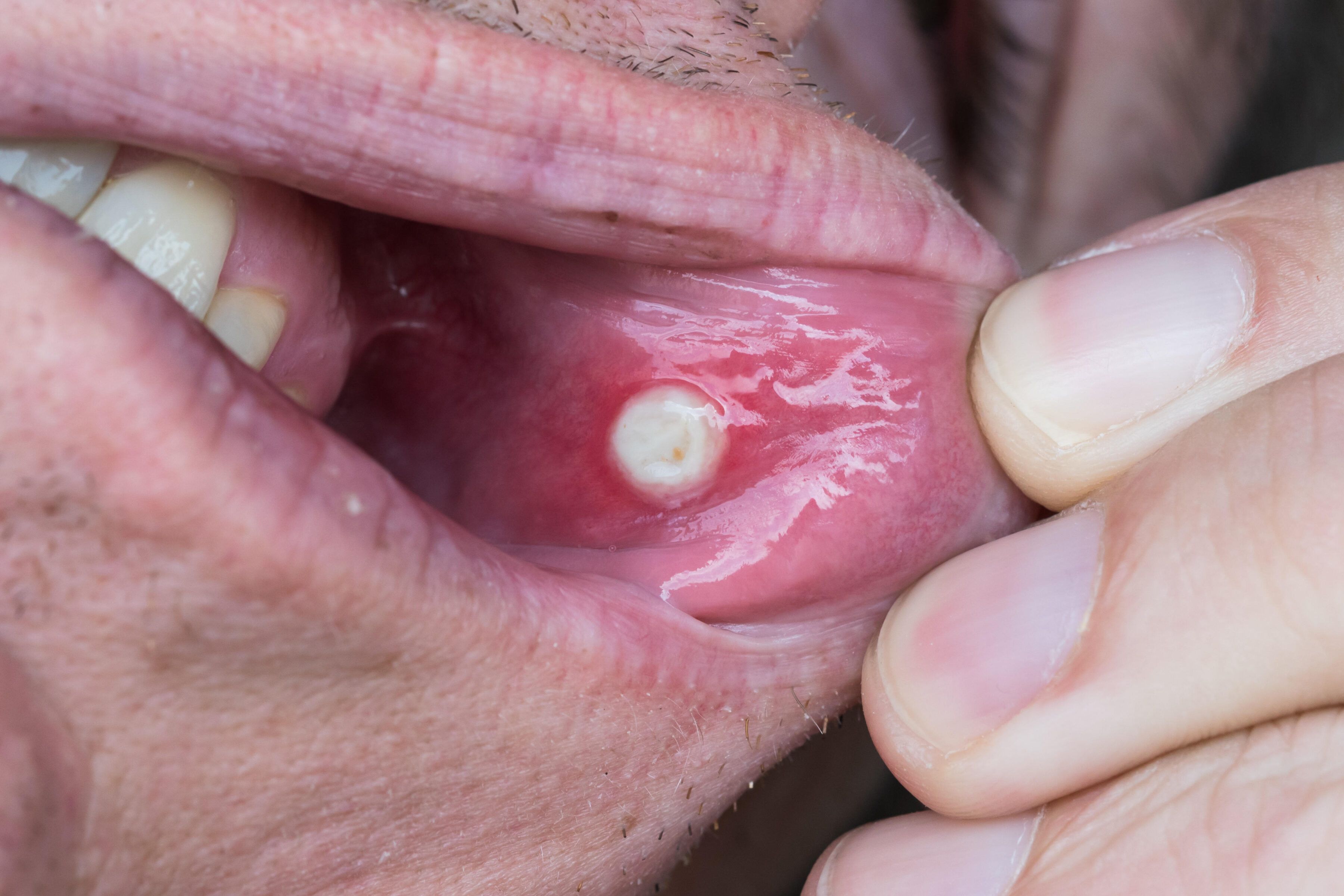 Clear Blister In Mouth