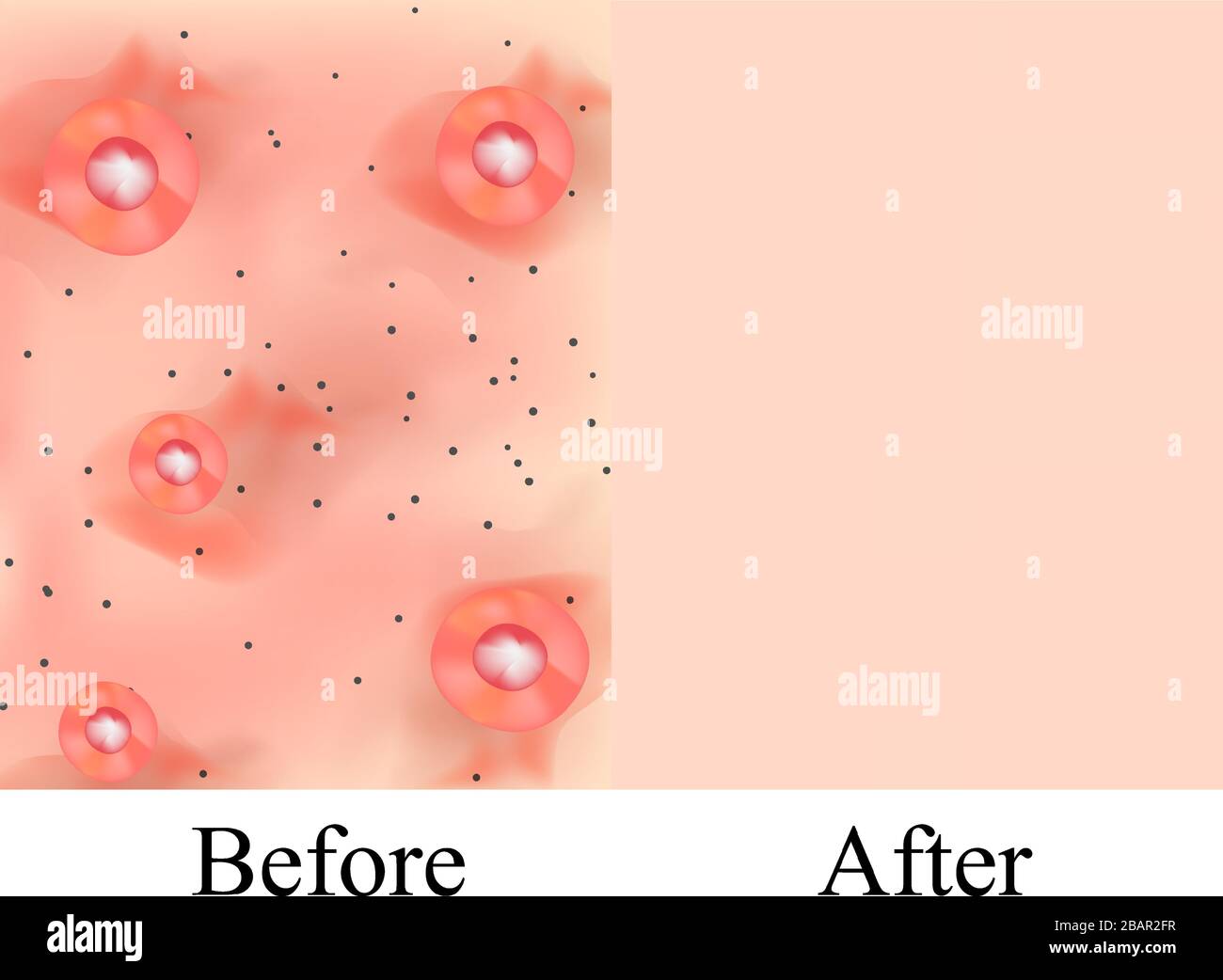 Clear Fluid From Pimple