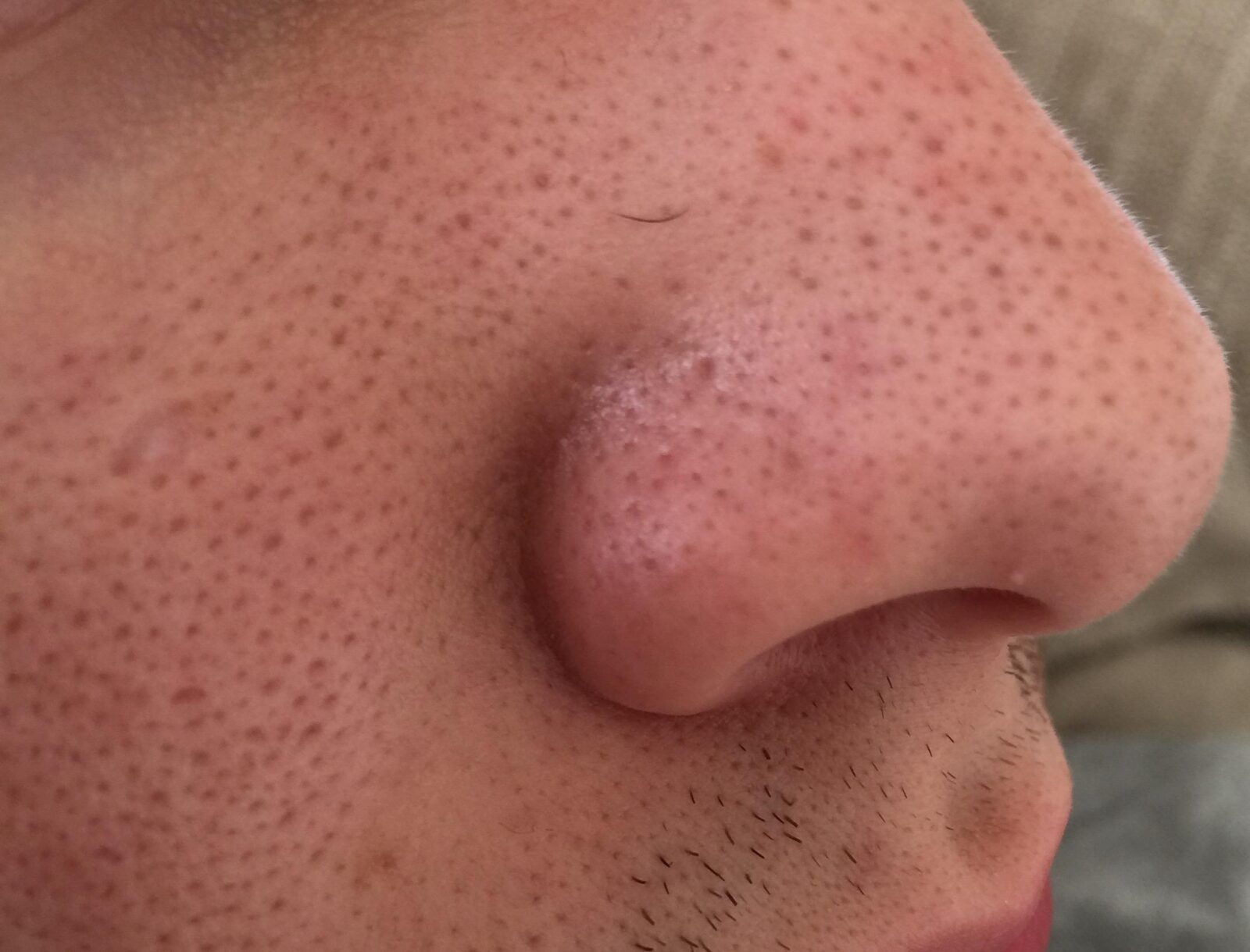 Clogged Pores On Nose