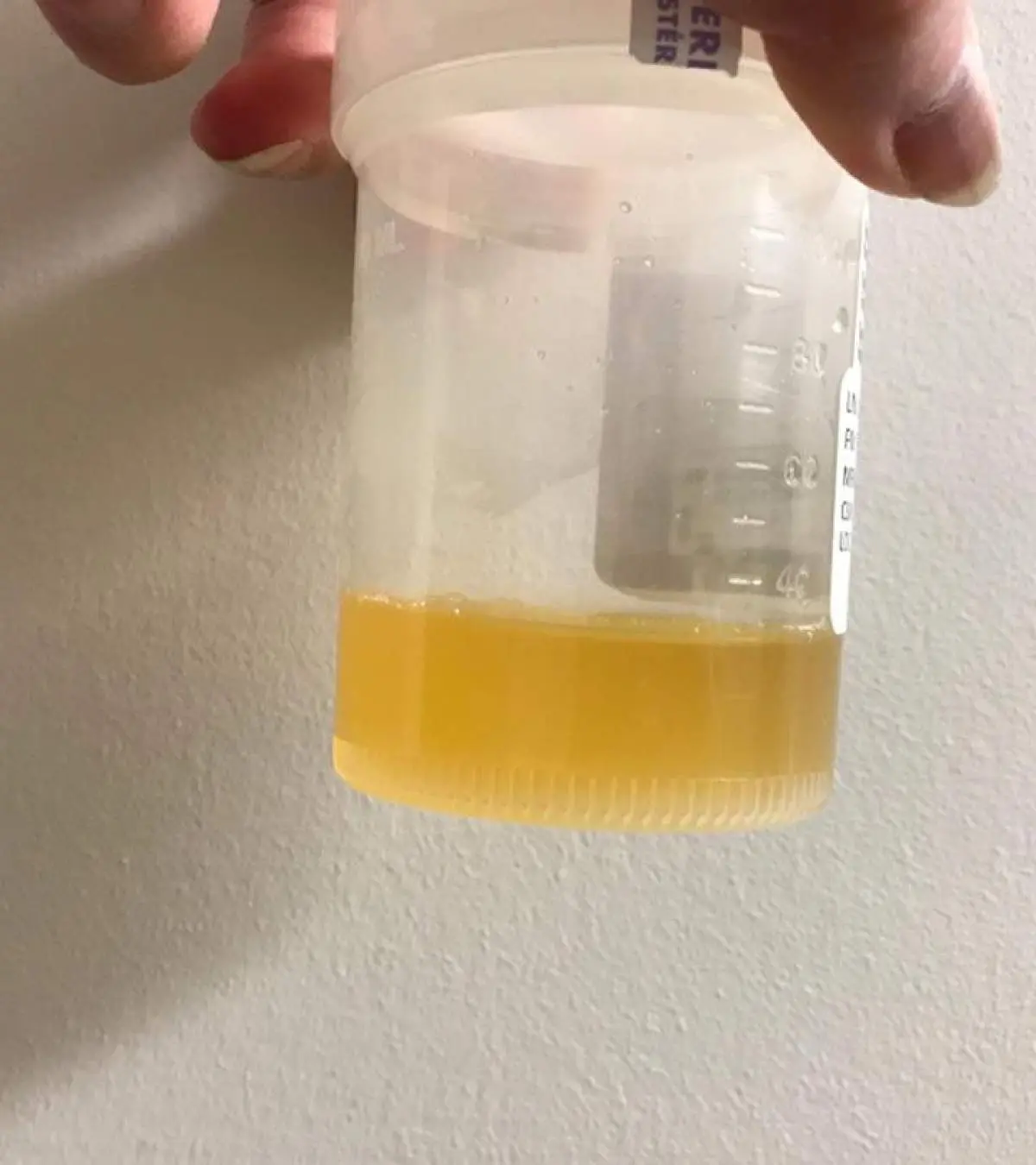 Cloudy Urine Pregnancy