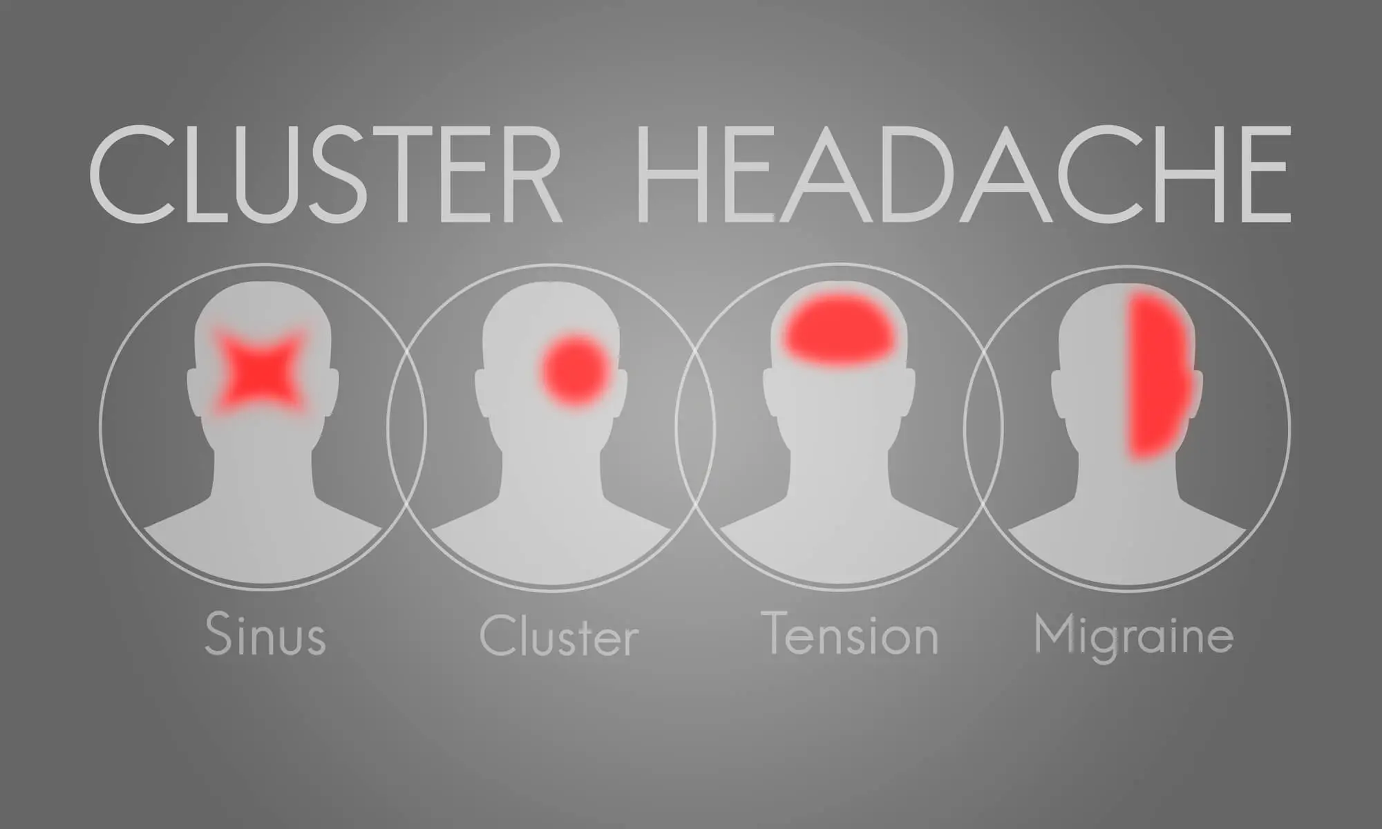 Cluster Headache Causes