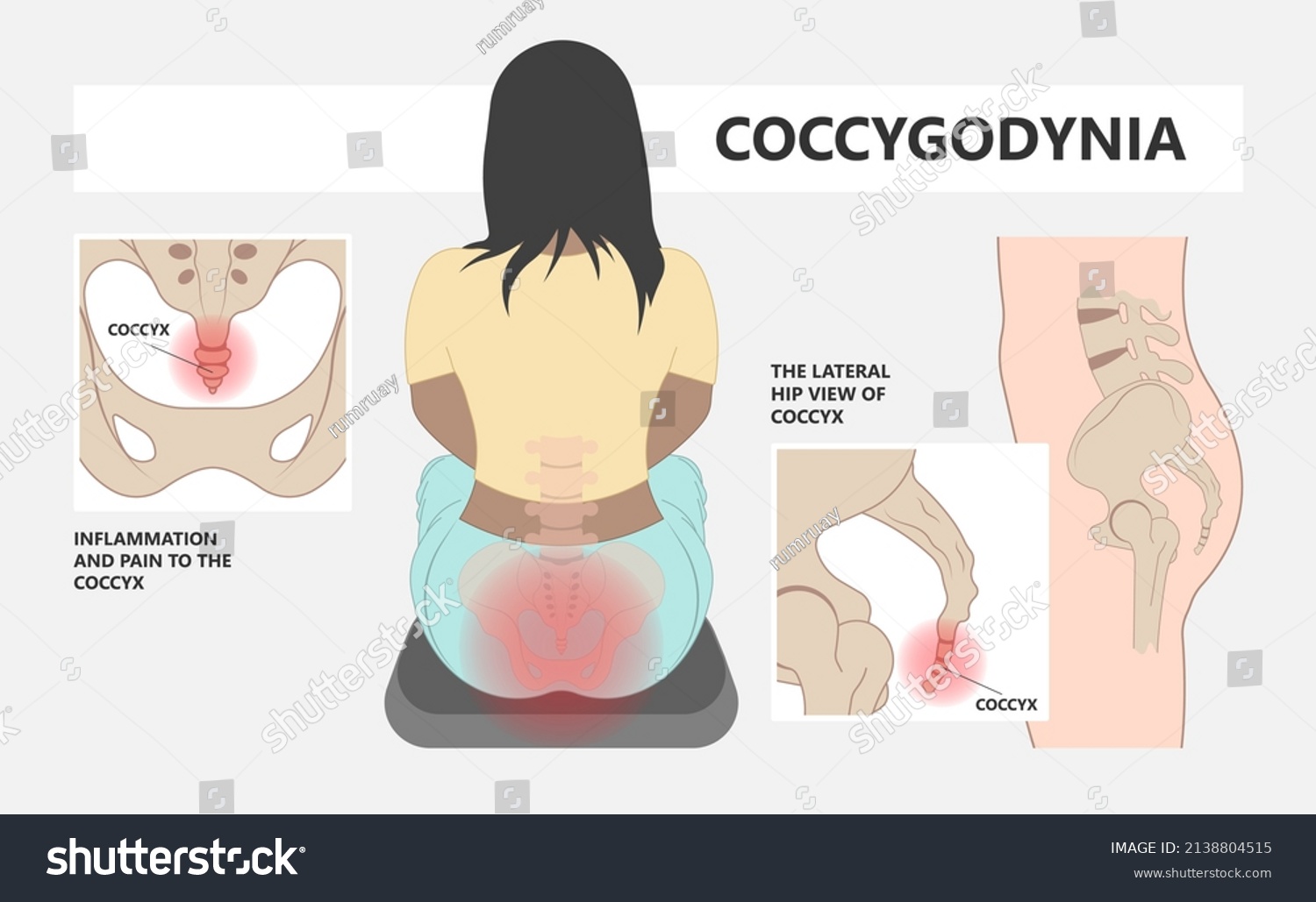 Coccyx Hurts When Sitting