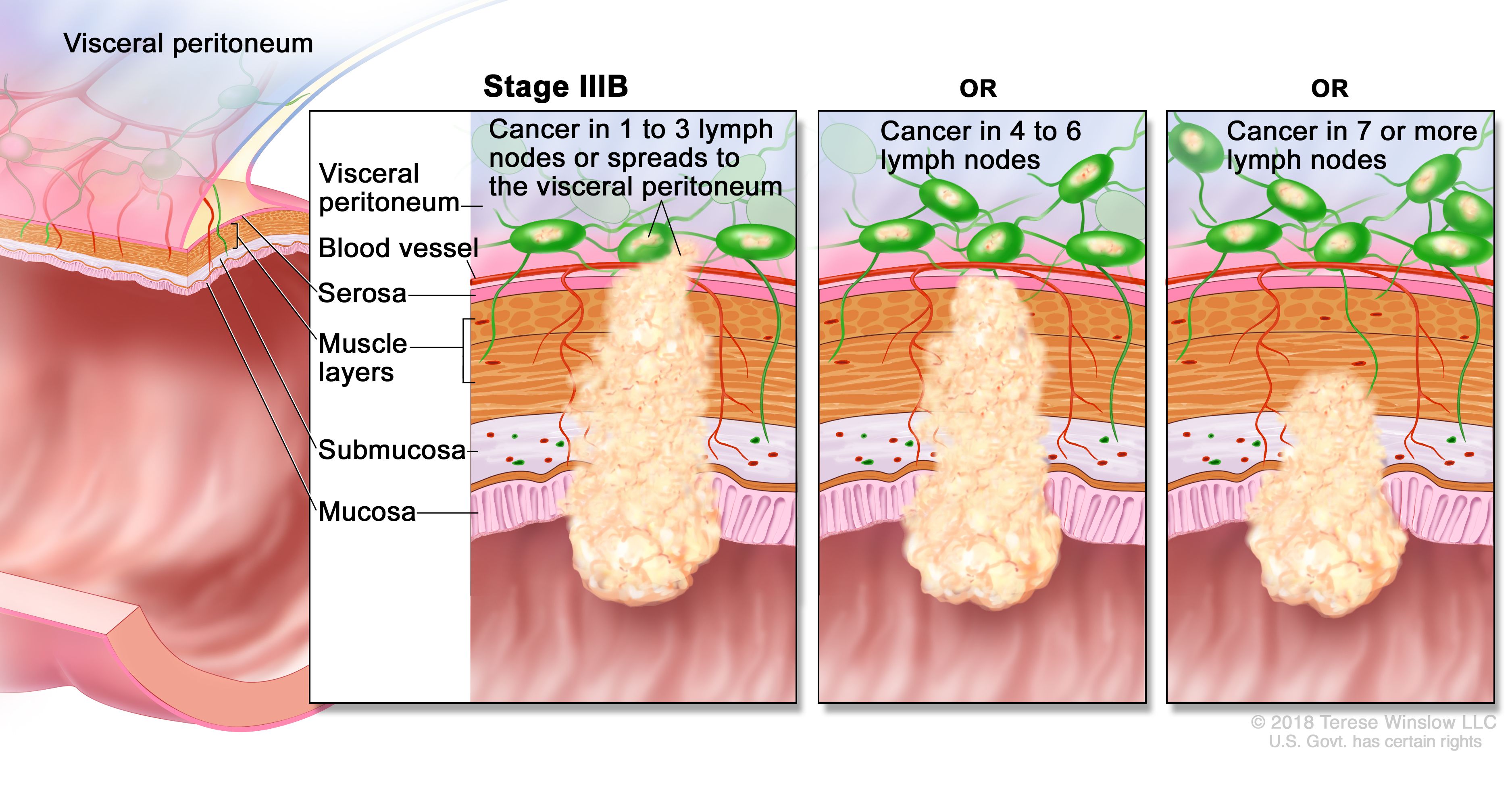 Colon Cancer Stages