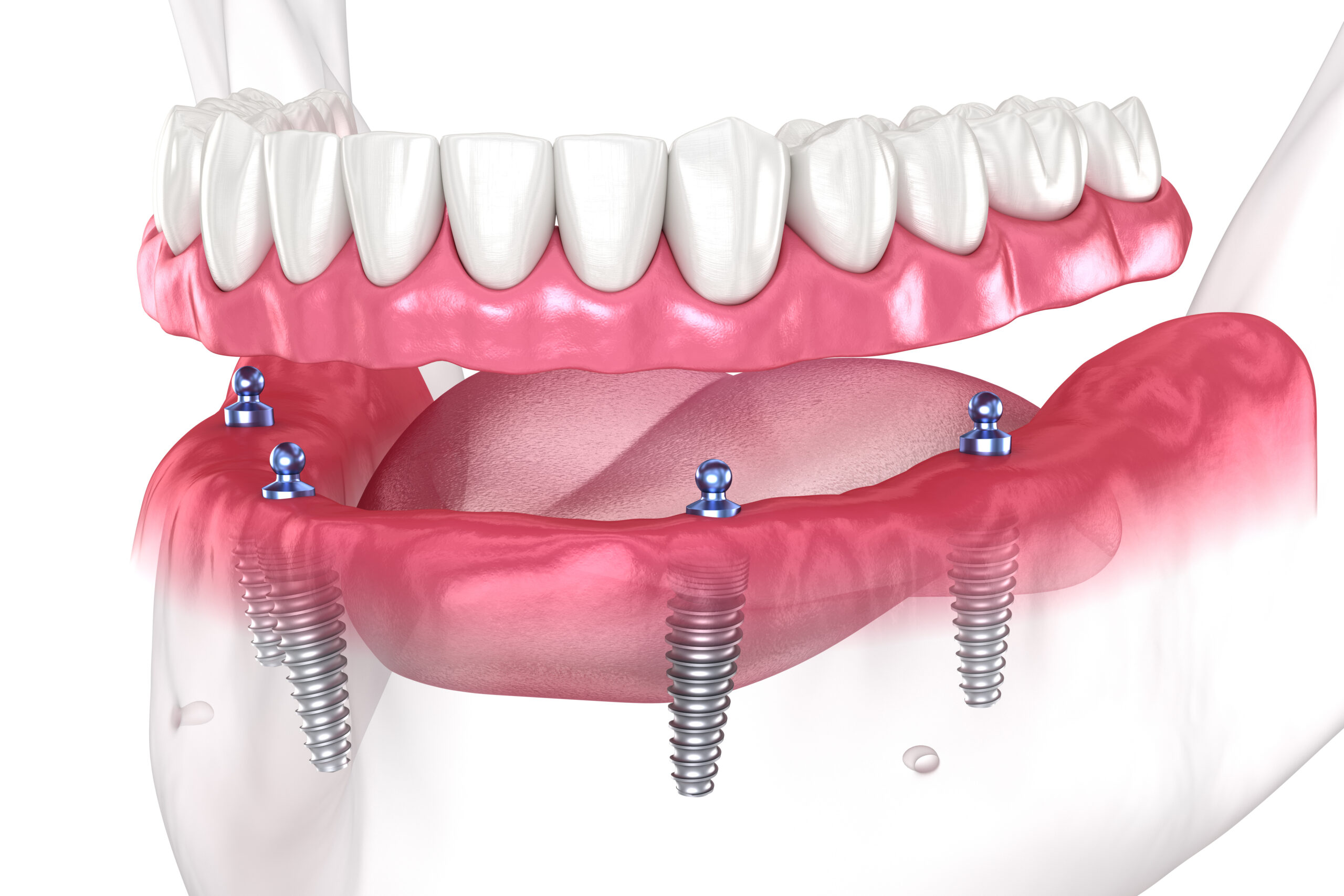 Complete Mouth Dental Implants
