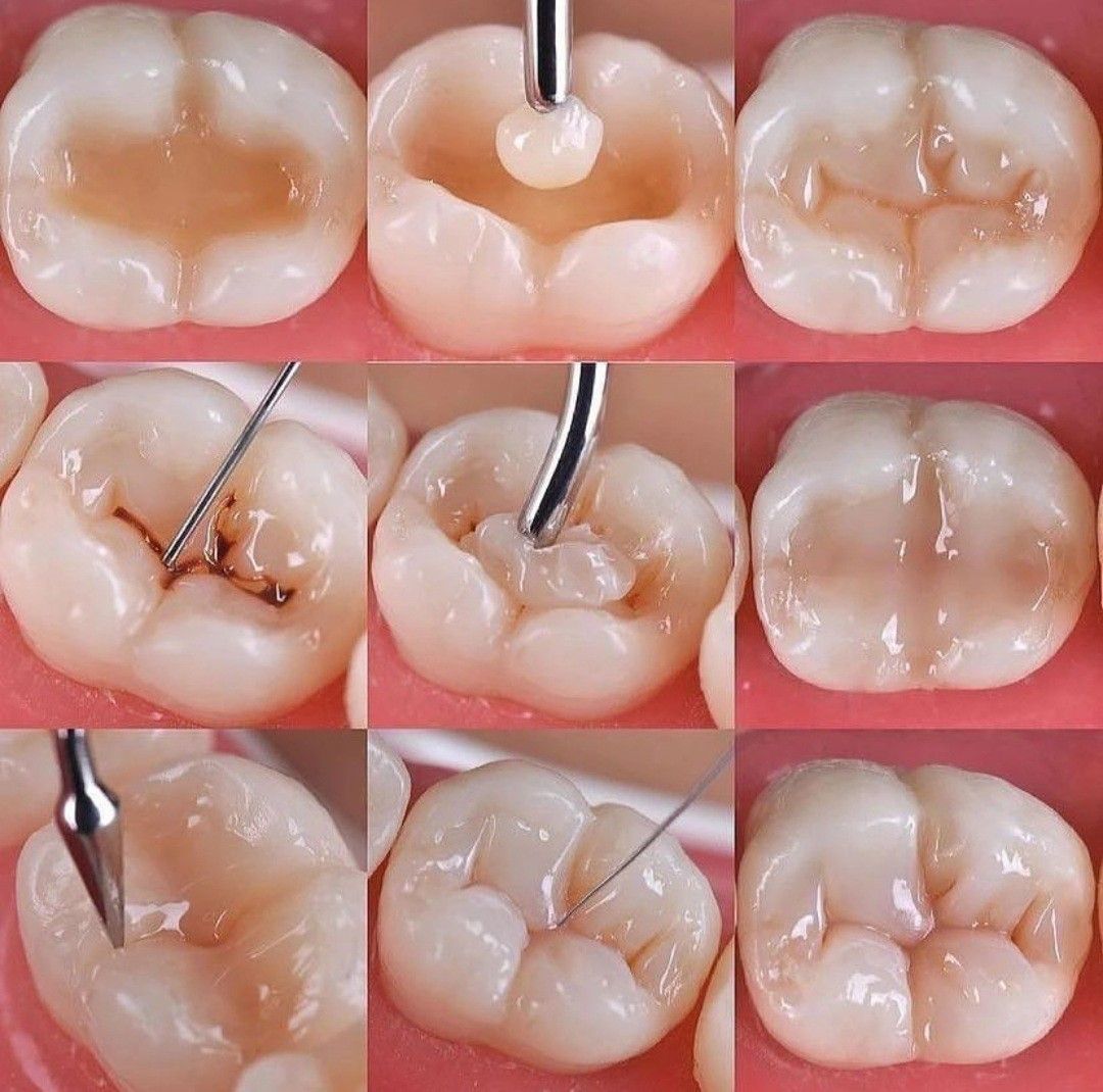 Composite Tooth Filling