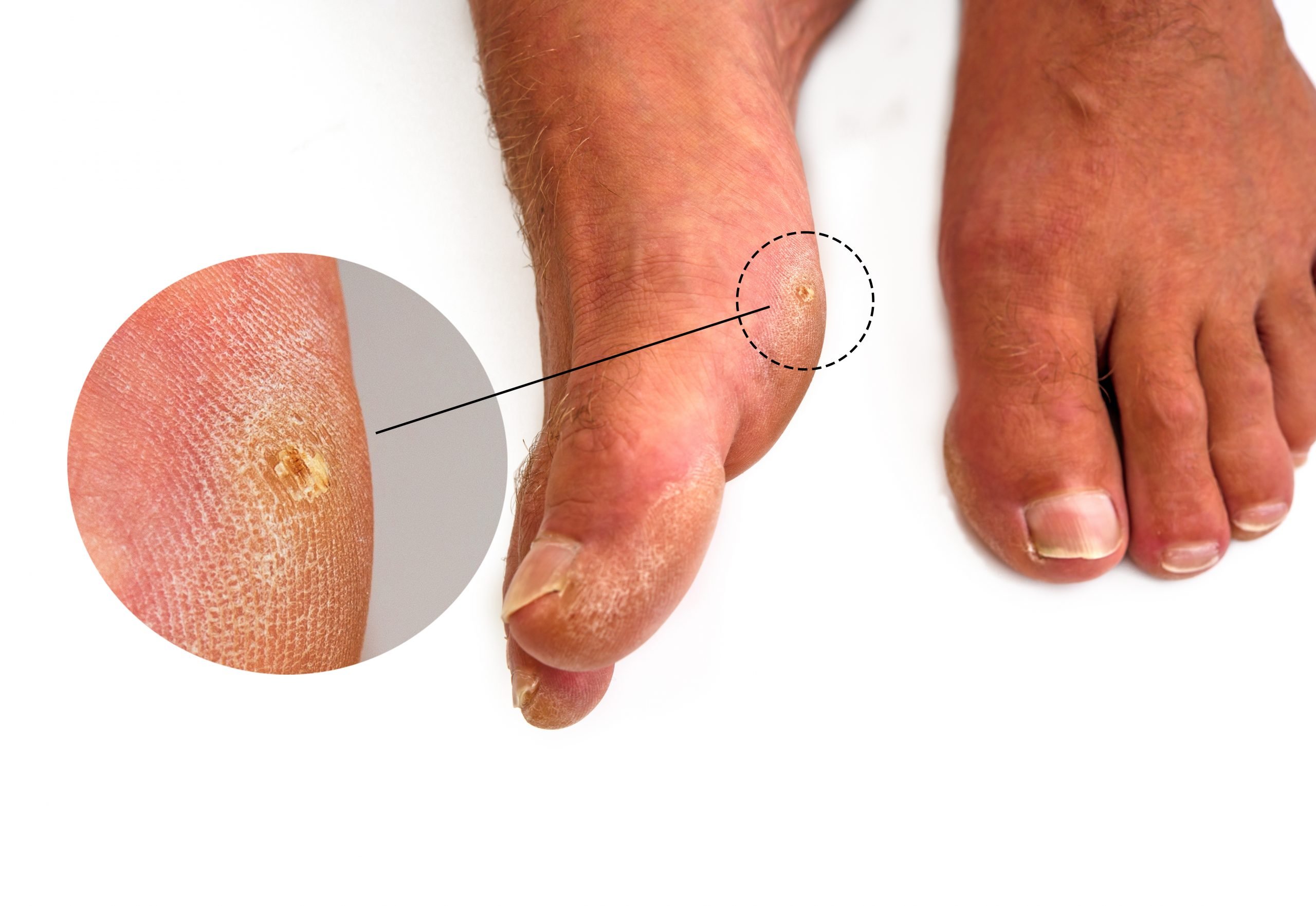 Corn Vs Callus