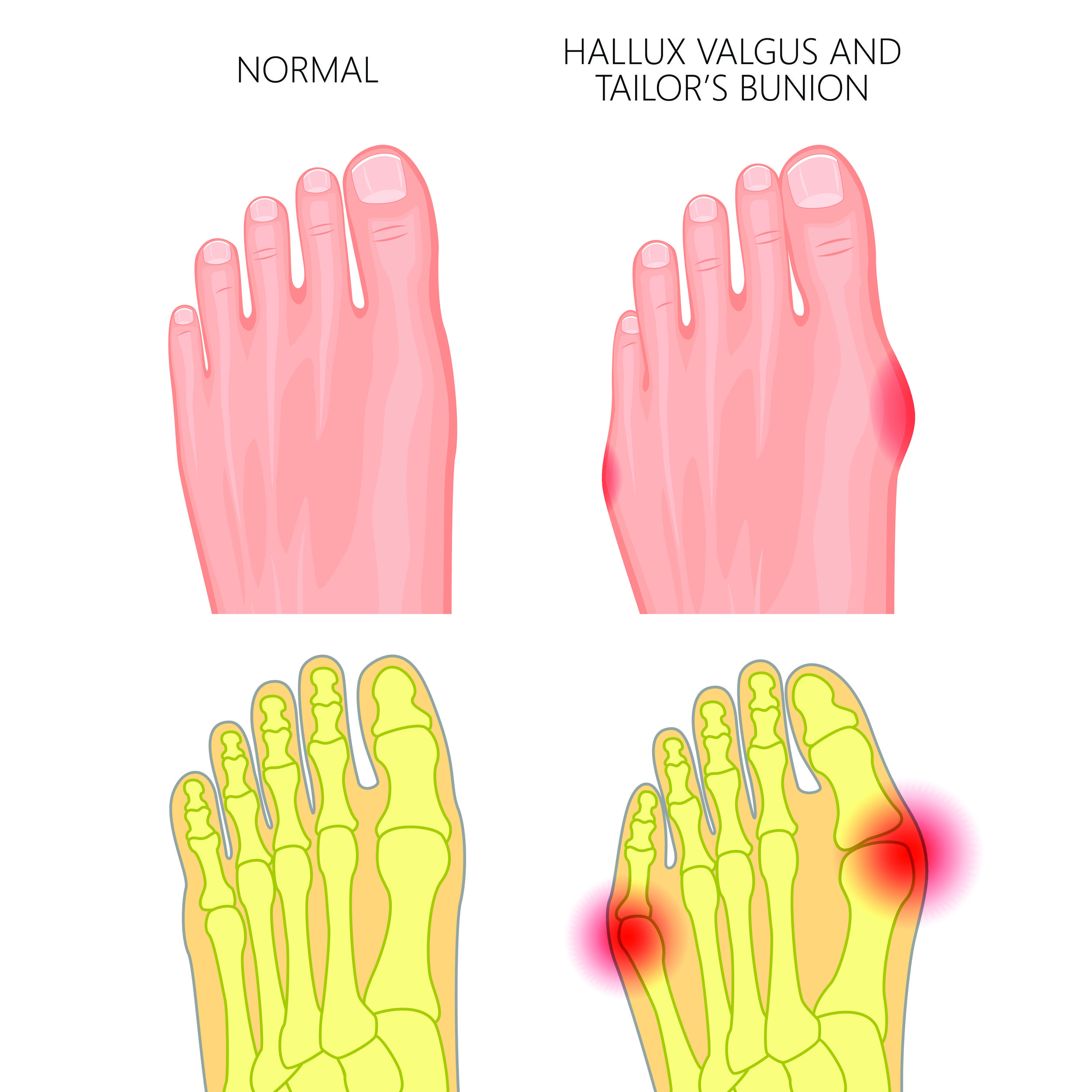 Corns And Bunions