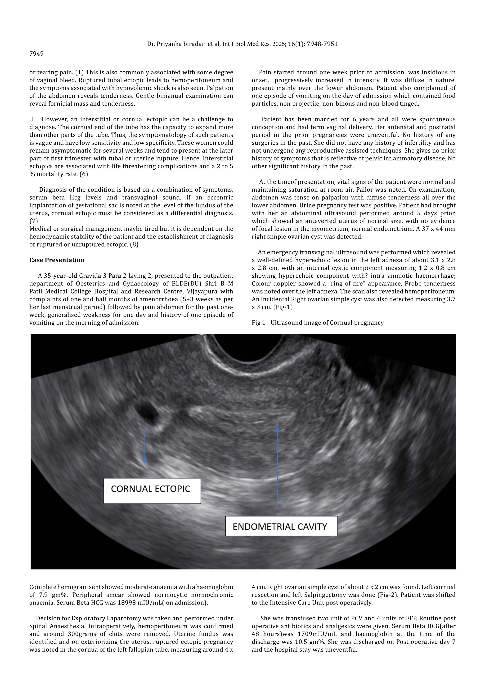 Cornual Interstitial Pregnancy