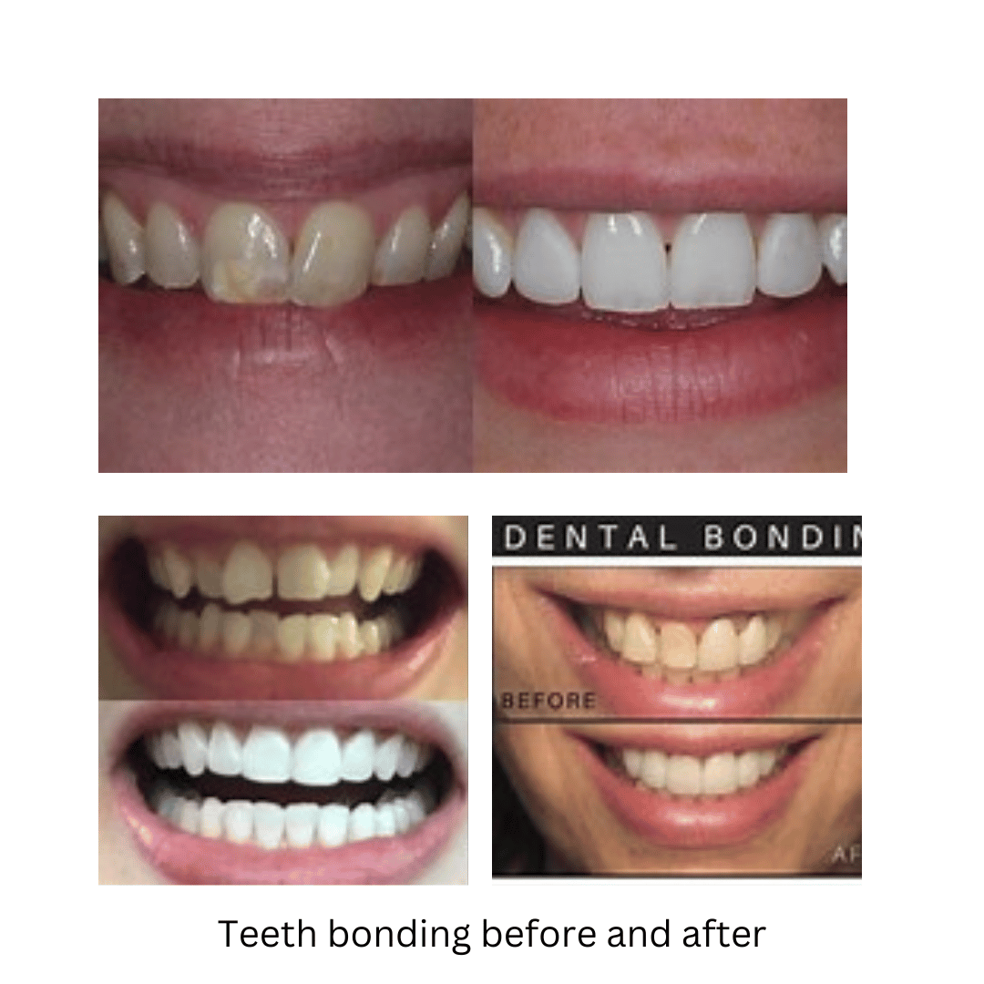 Cosmetic Dental Bonding
