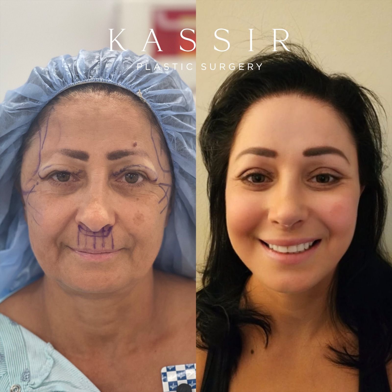 Cost Of Face Plastic Surgery