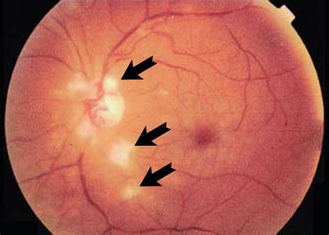 Cotton Wool Spots Retina