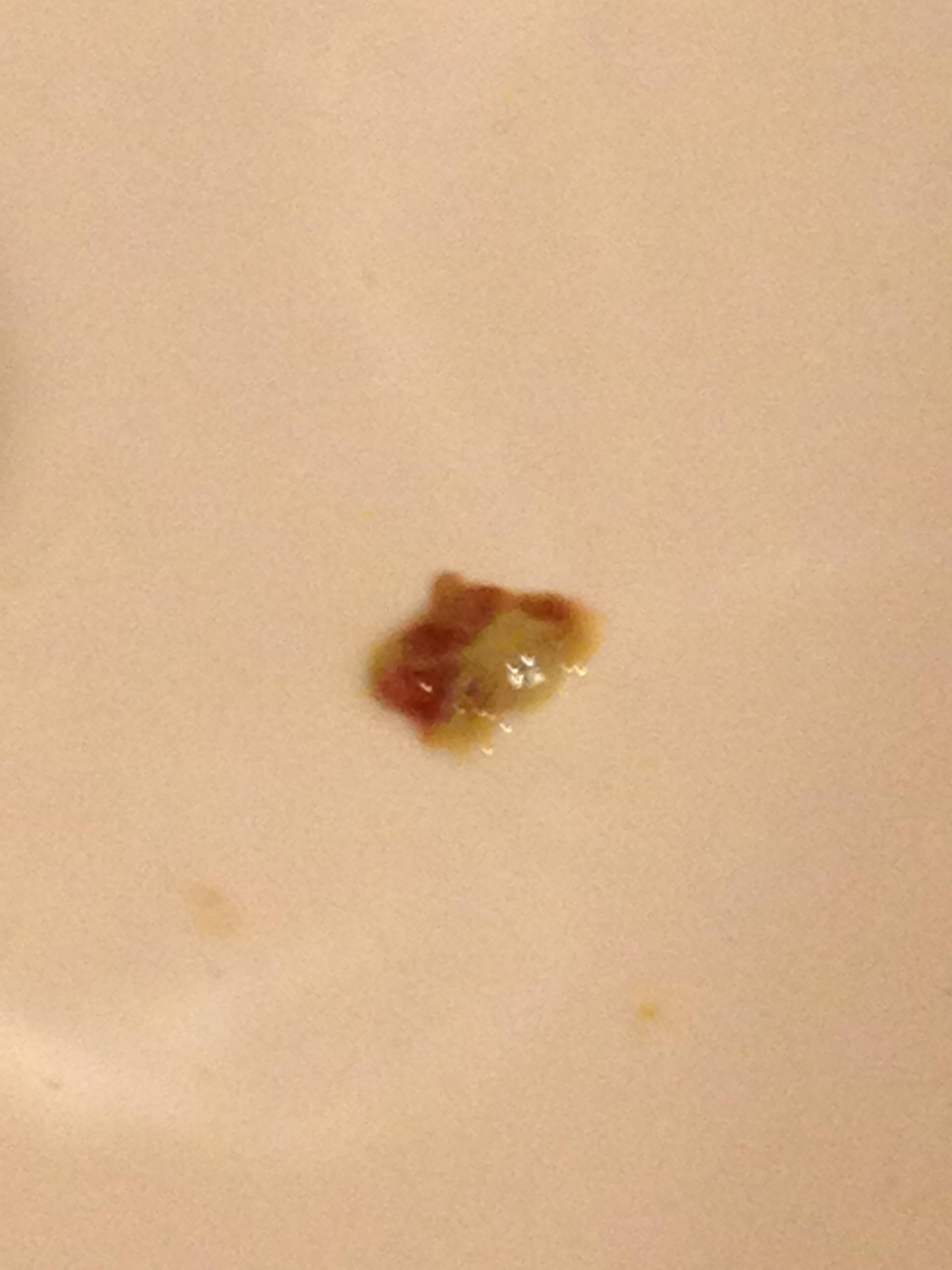 Coughing Up Green Mucus