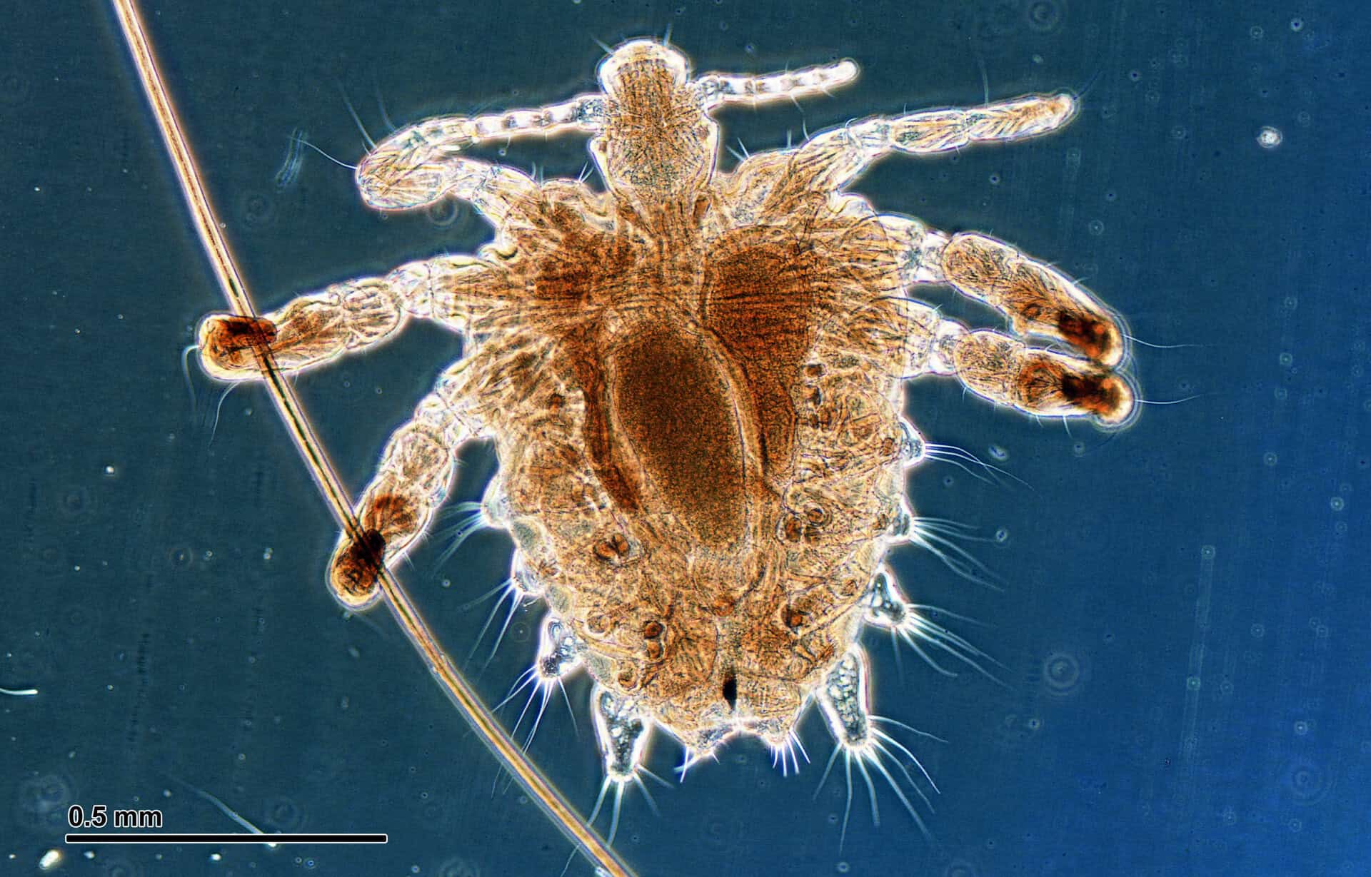 Crabs Pubic Lice Photos