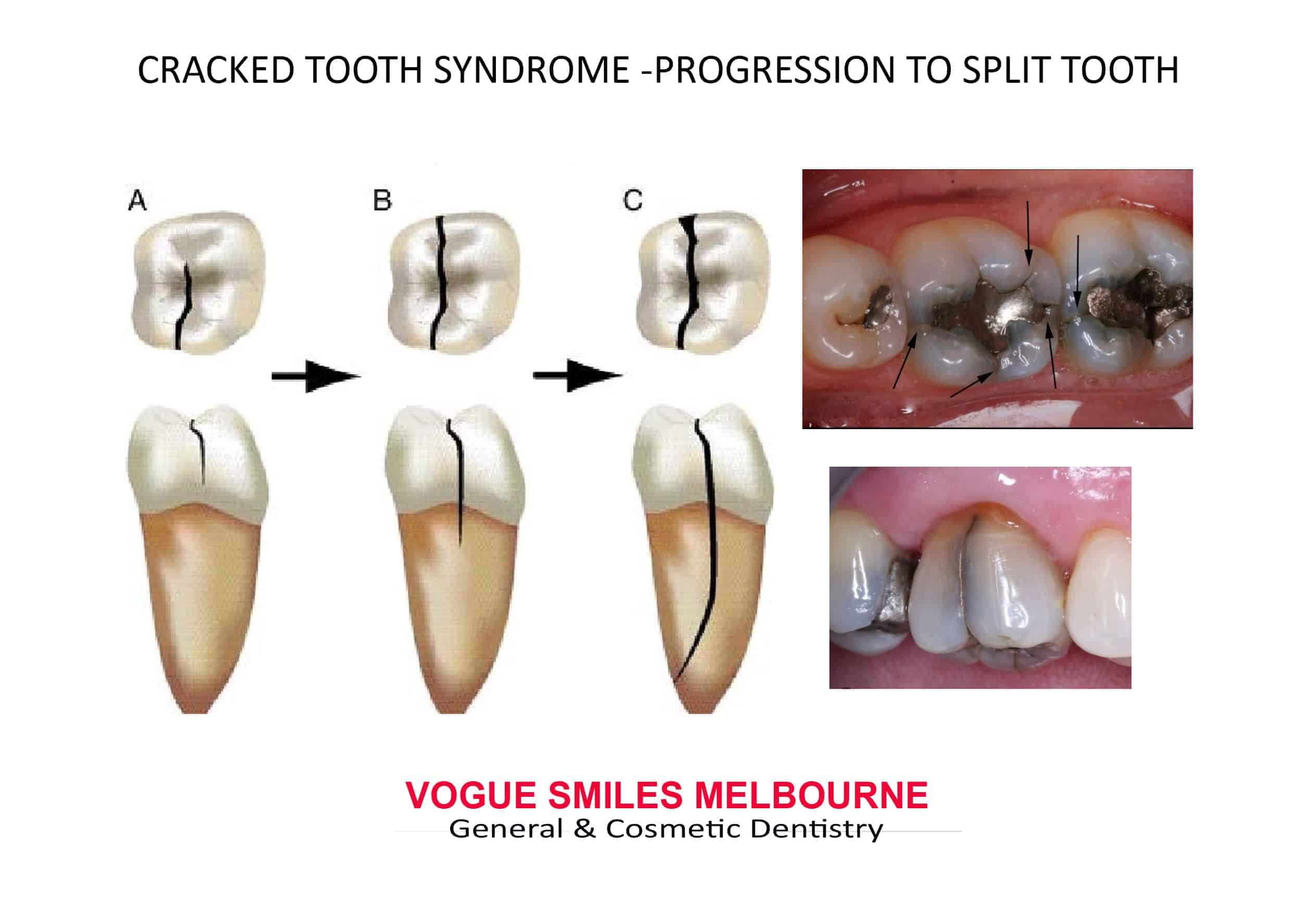 Crack On Tooth