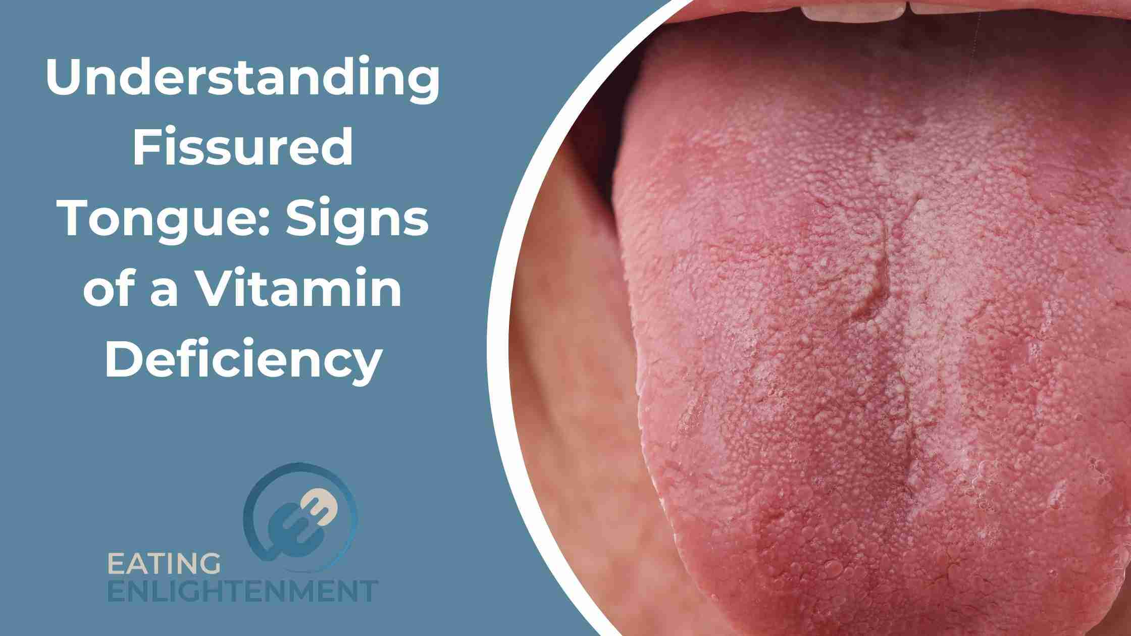 Cracks In Tongue Vitamin Deficiency