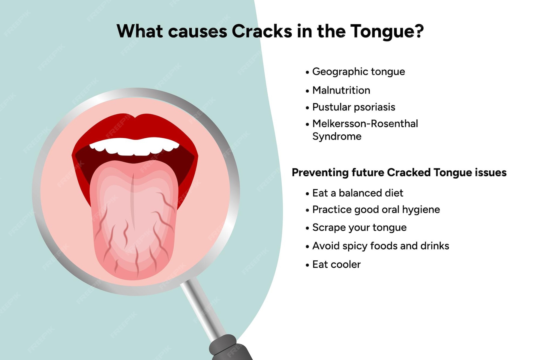 Cracks In Tongue