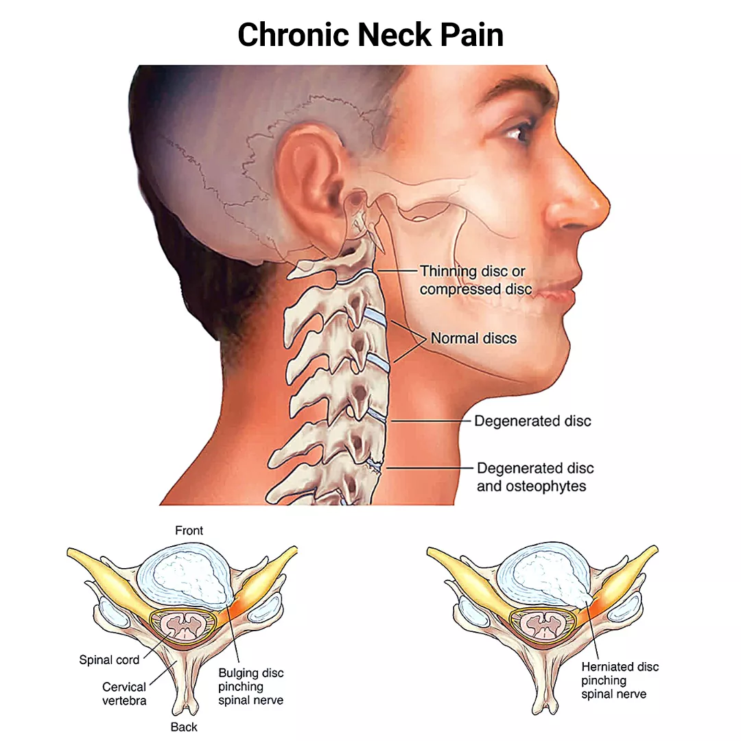 Crick In Neck Turning Right