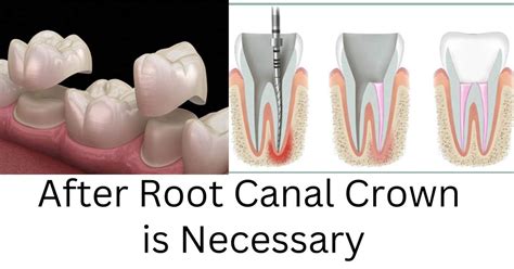 Crown After Root Canal
