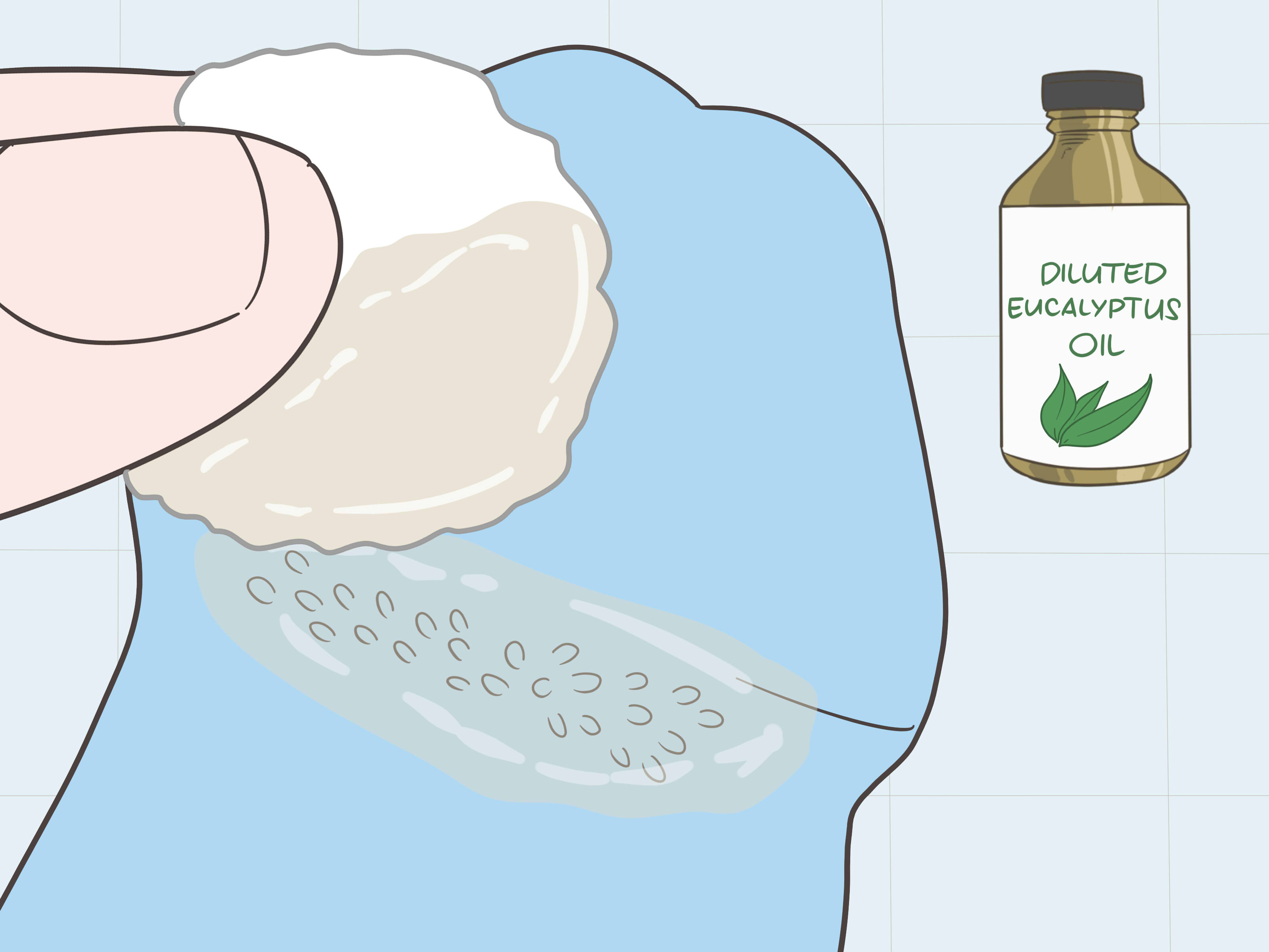 Cryotherapy For Pearly Penile Papules